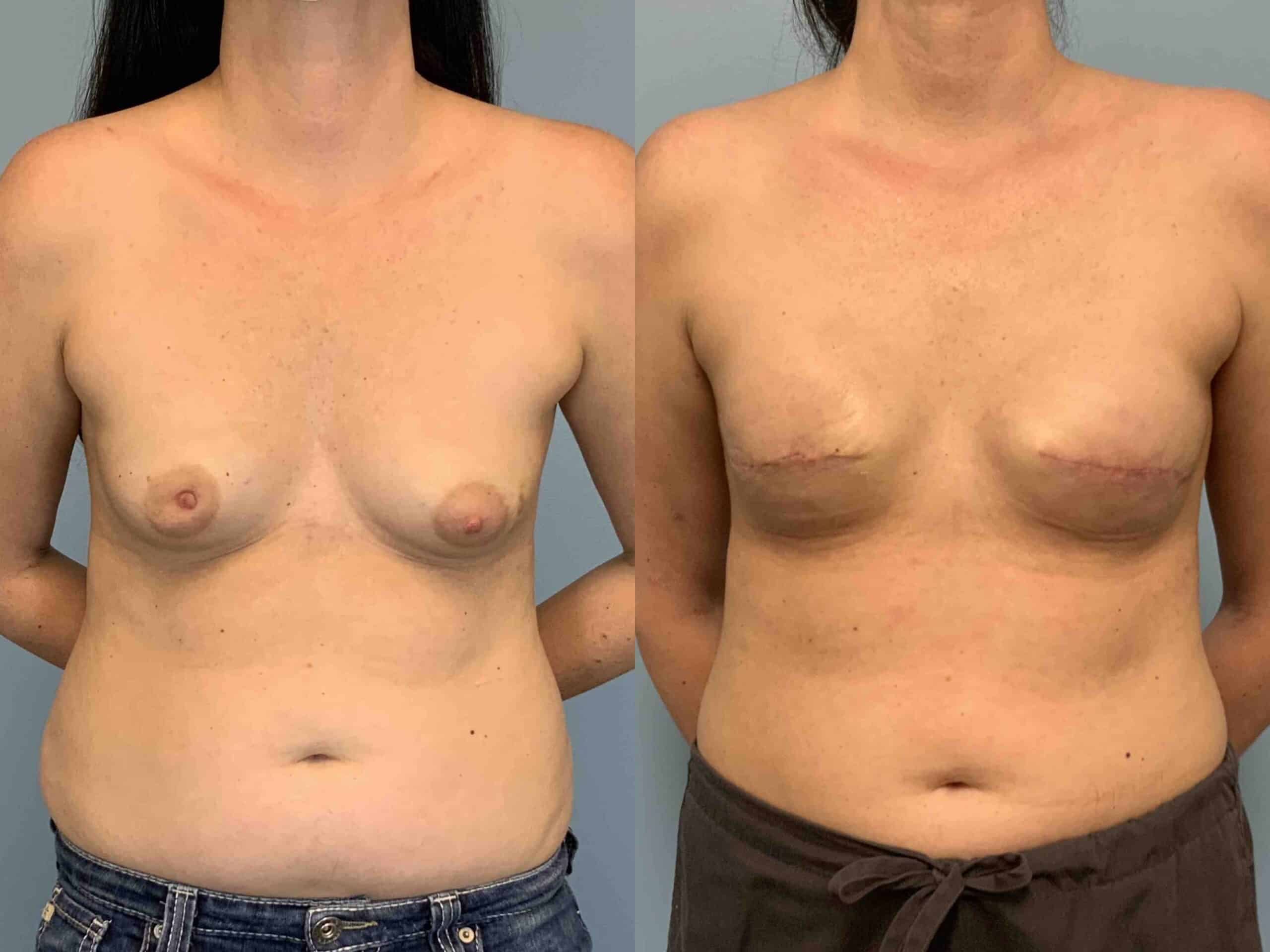 Before and after, 2 mo post op from Breast Reconstruction with Implant/Prepectoral performed by Dr. Paul Vanek (front view)
