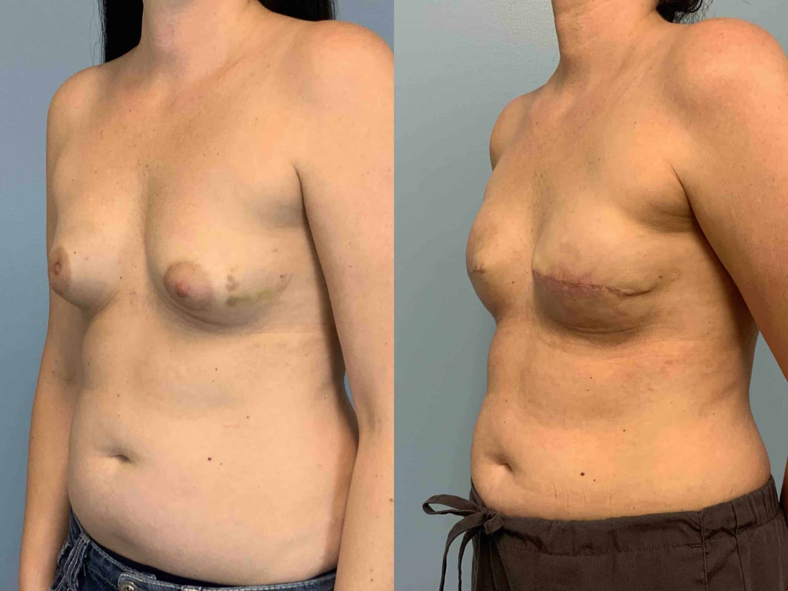 Before and after, 2 mo post op from Breast Reconstruction with Implant/Prepectoral performed by Dr. Paul Vanek (diagonal view)