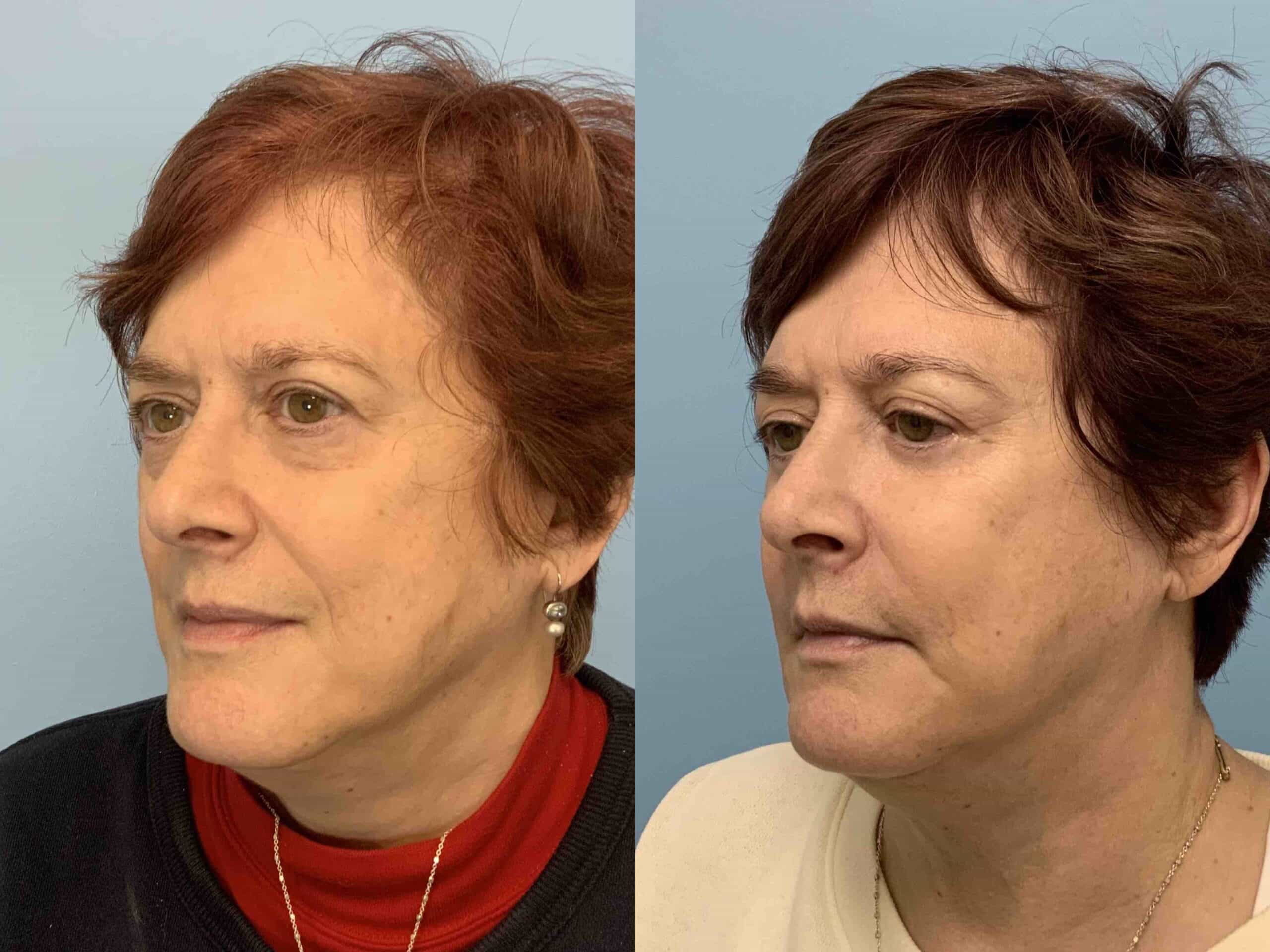 Before and after, 2y 8mo post op from Lower Blepharoplasty, Canthopexy performed by Dr. Paul Vanek (diagonal view)