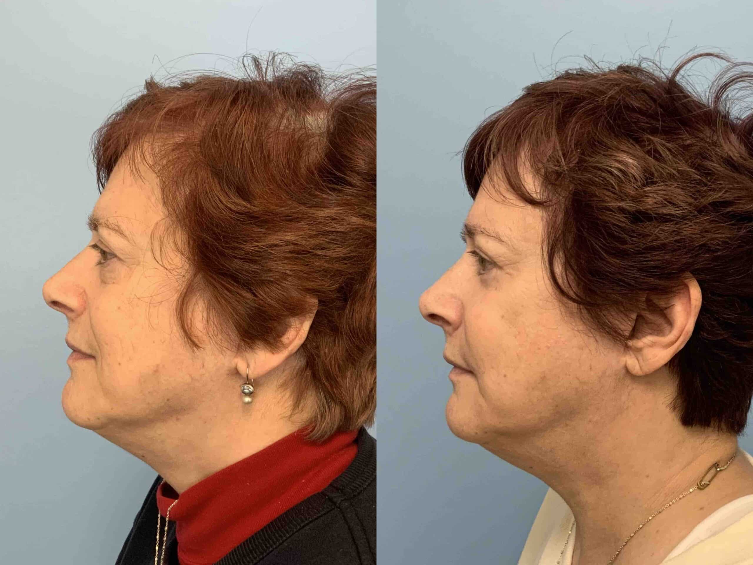 Before and after, 2y 8mo post op from Lower Blepharoplasty, Canthopexy performed by Dr. Paul Vanek (side view)