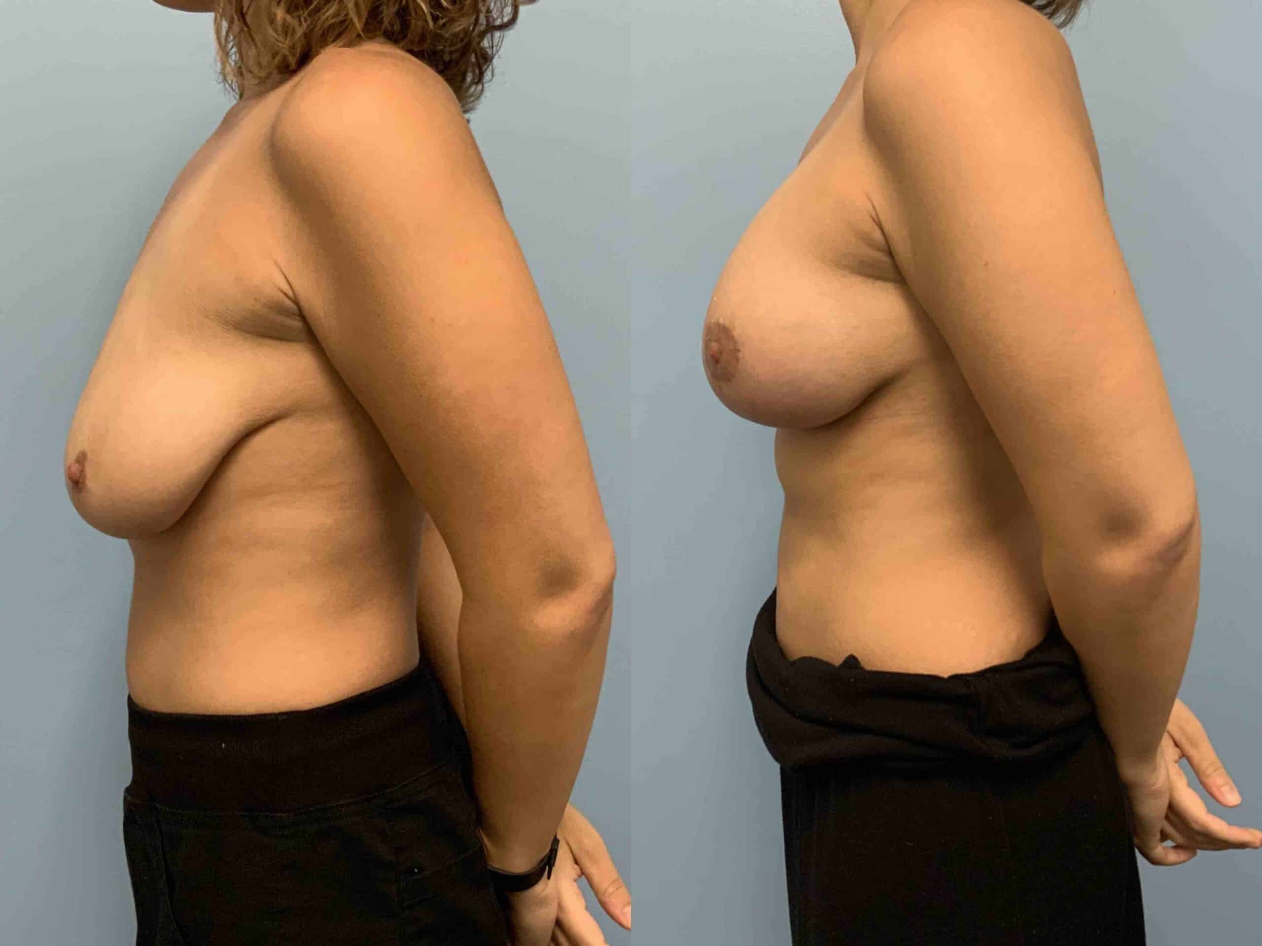 Before and after, 6 mo post op from Breast Augmentation with Breast Lift/Mastopexy & Galaflex Reinforcement performed by Dr. Paul Vanek (side view)