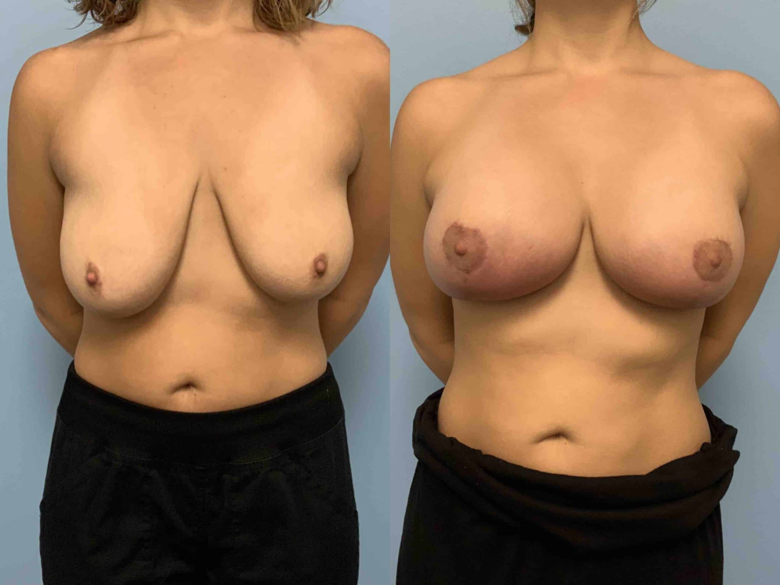 Before and after, 6 mo post op from Breast Augmentation with Breast Lift/Mastopexy & Galaflex Reinforcement performed by Dr. Paul Vanek (front view)