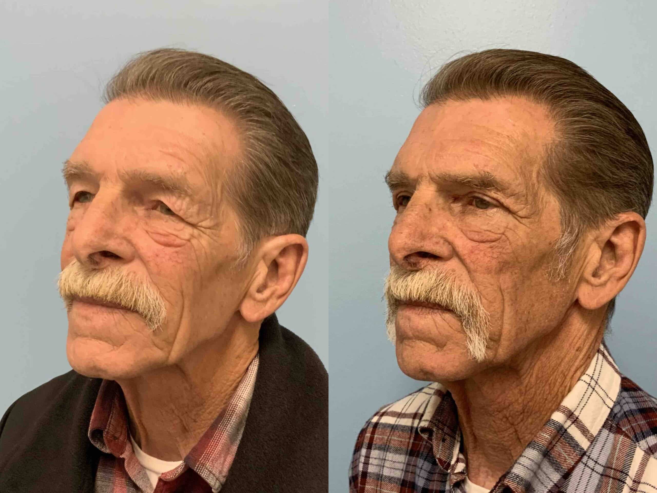 Before and after, 1 mo post op from upper blepharoplasty performed by Dr. Paul Vanek (diagonal view)