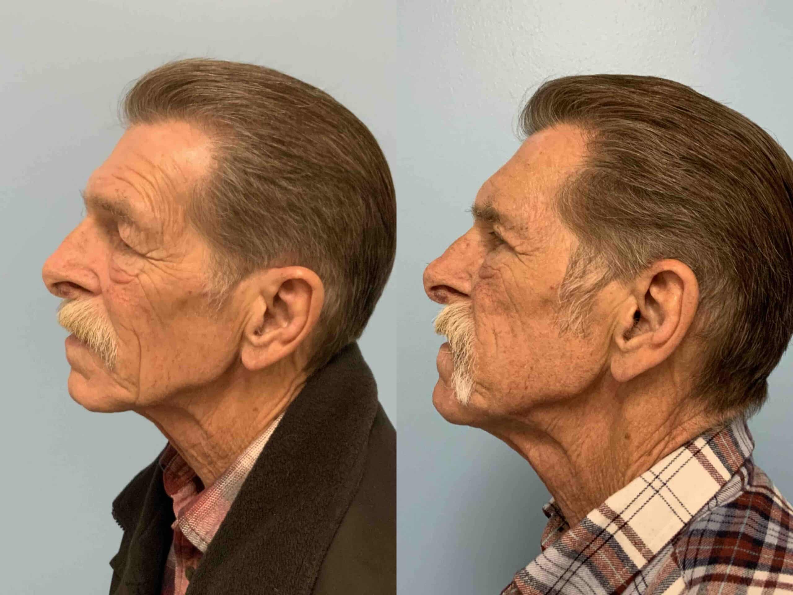 Before and after, 1 mo post op from upper blepharoplasty performed by Dr. Paul Vanek (side view)