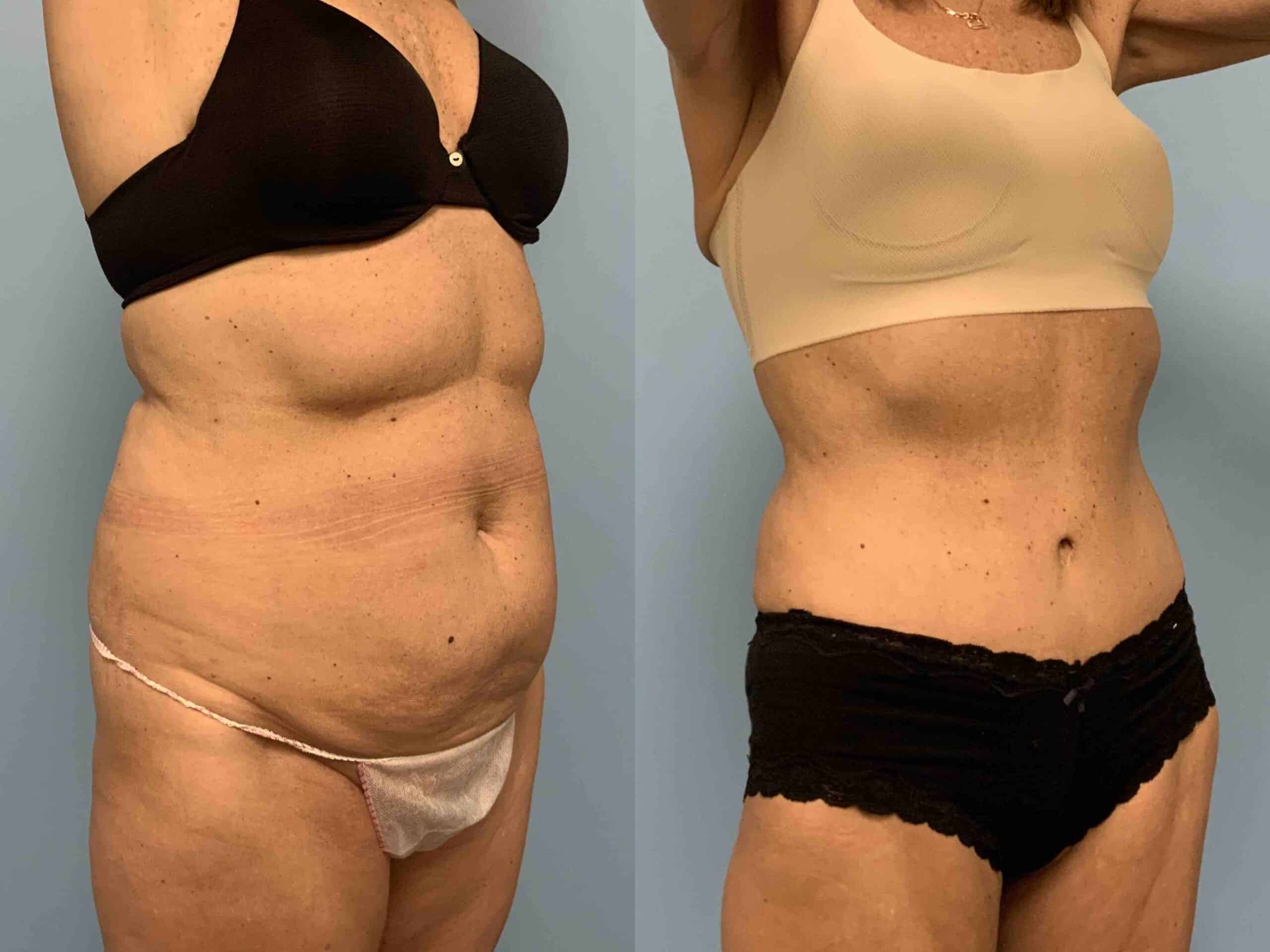 Before and after, 10 mo post op from Tummy Tuck, VASER Abdomen, Flanks, and Mons performed by Dr. Paul Vanek (diagonal view)
