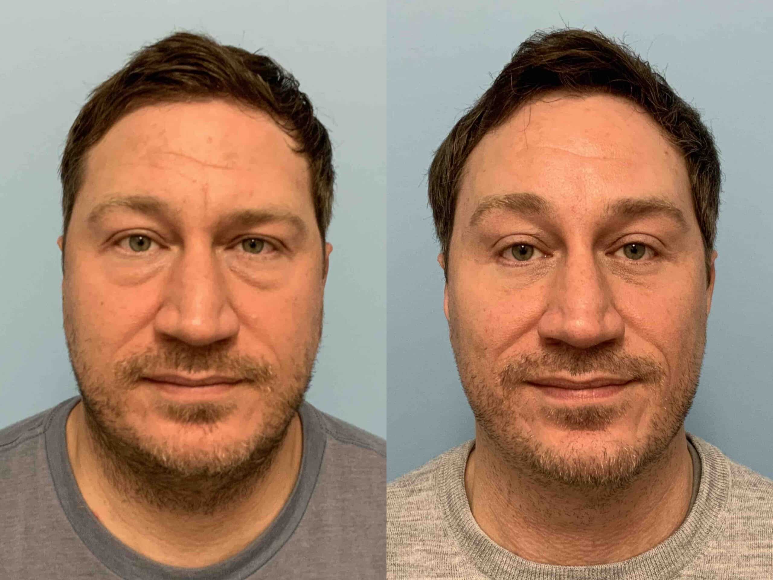 Before and after, 10 mo post op from Lower Blepharoplasty, Canthopexy, Endo Brow lift performed by Dr. Paul Vanek (front view)