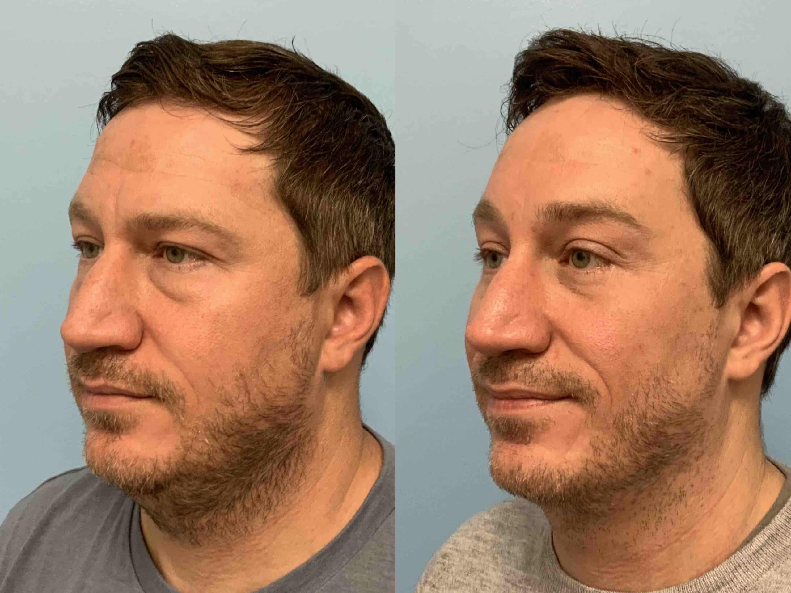 Before and after, 10 mo post op from Lower Blepharoplasty, Canthopexy, Endo Brow lift performed by Dr. Paul Vanek (diagonal view)