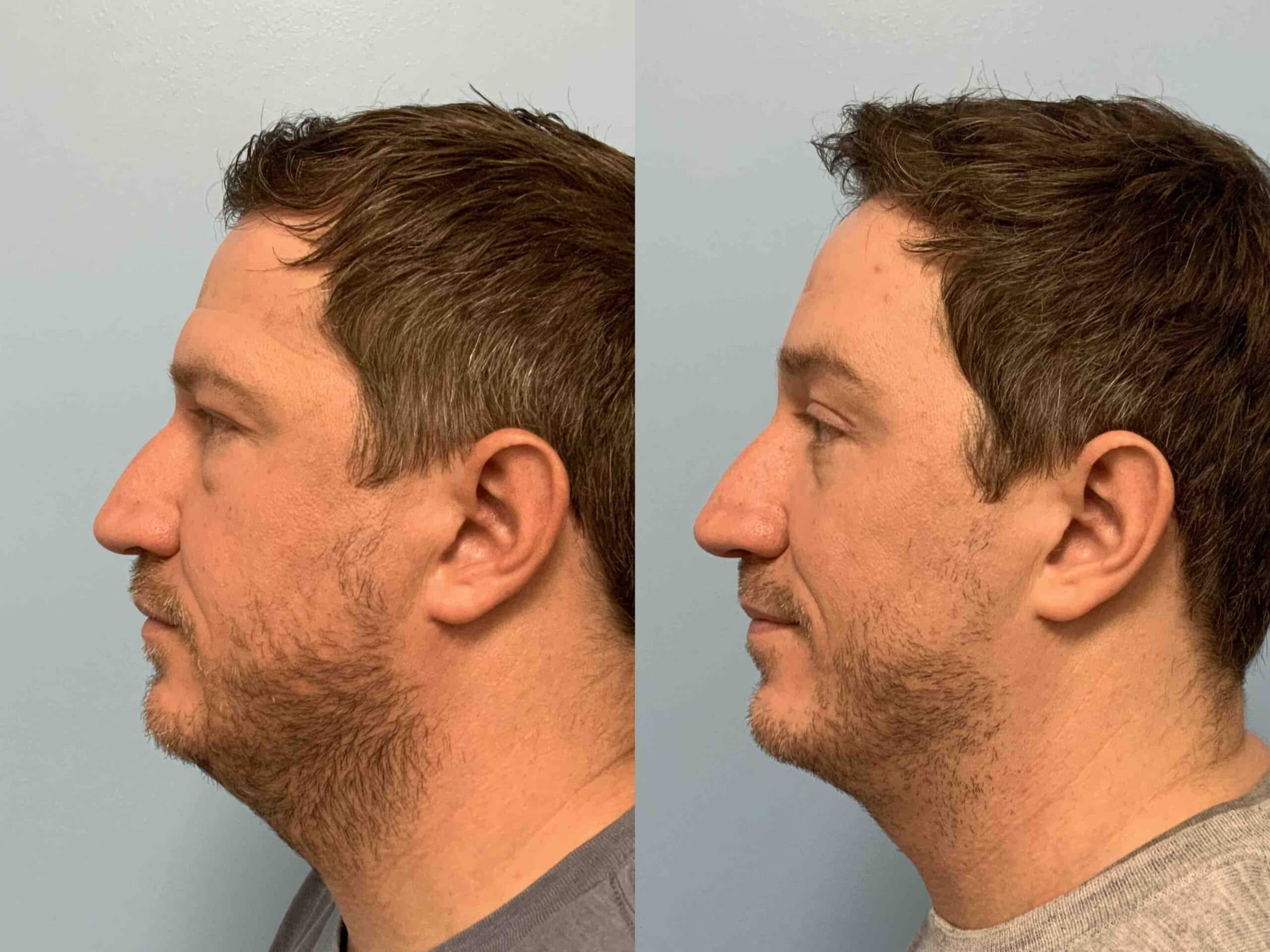 Before and after, 10 mo post op from Lower Blepharoplasty, Canthopexy, Endo Brow lift performed by Dr. Paul Vanek (side view)