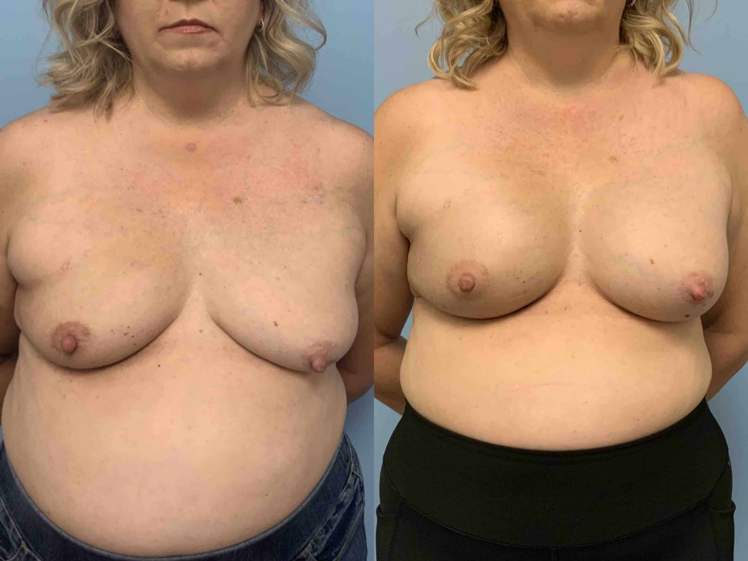 Before and after, 2 mo post op from Right Irradiated Breast Reconstruction, B/L Mastopexy, B/L Breast Augmentation with Alloderm performed by Dr. Paul Vanek (front view)
