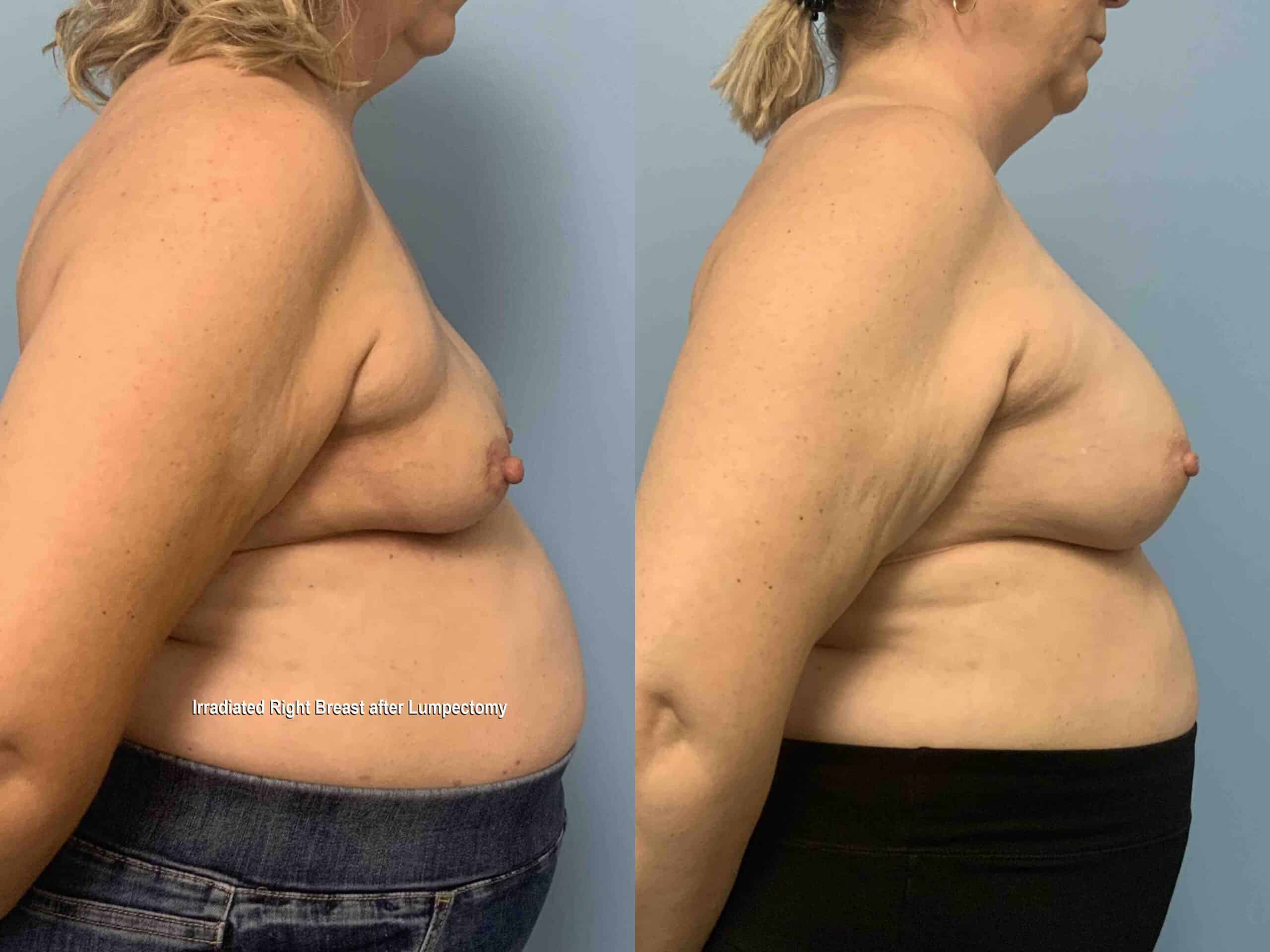 Before and after, 2 mo post op from Right Irradiated Breast Reconstruction, B/L Mastopexy, B/L Breast Augmentation with Alloderm performed by Dr. Paul Vanek (side view)