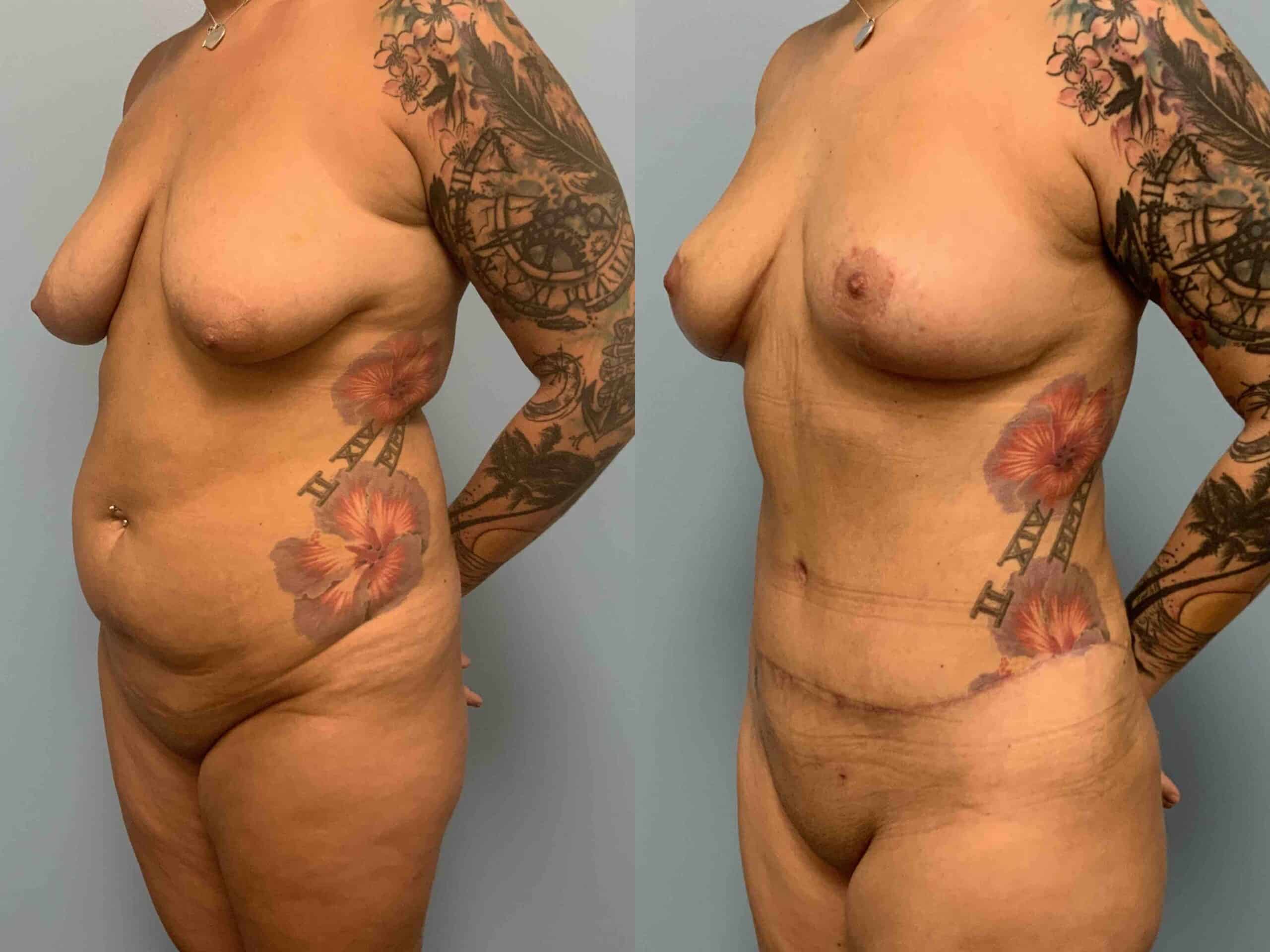 Before and after, 1 mo post op from VASER Abdomen, Axilla, Flanks, and Mons, Tummy Tuck, Breast Lift/Mastopexy performed by Dr. Paul Vanek (diagonal view)