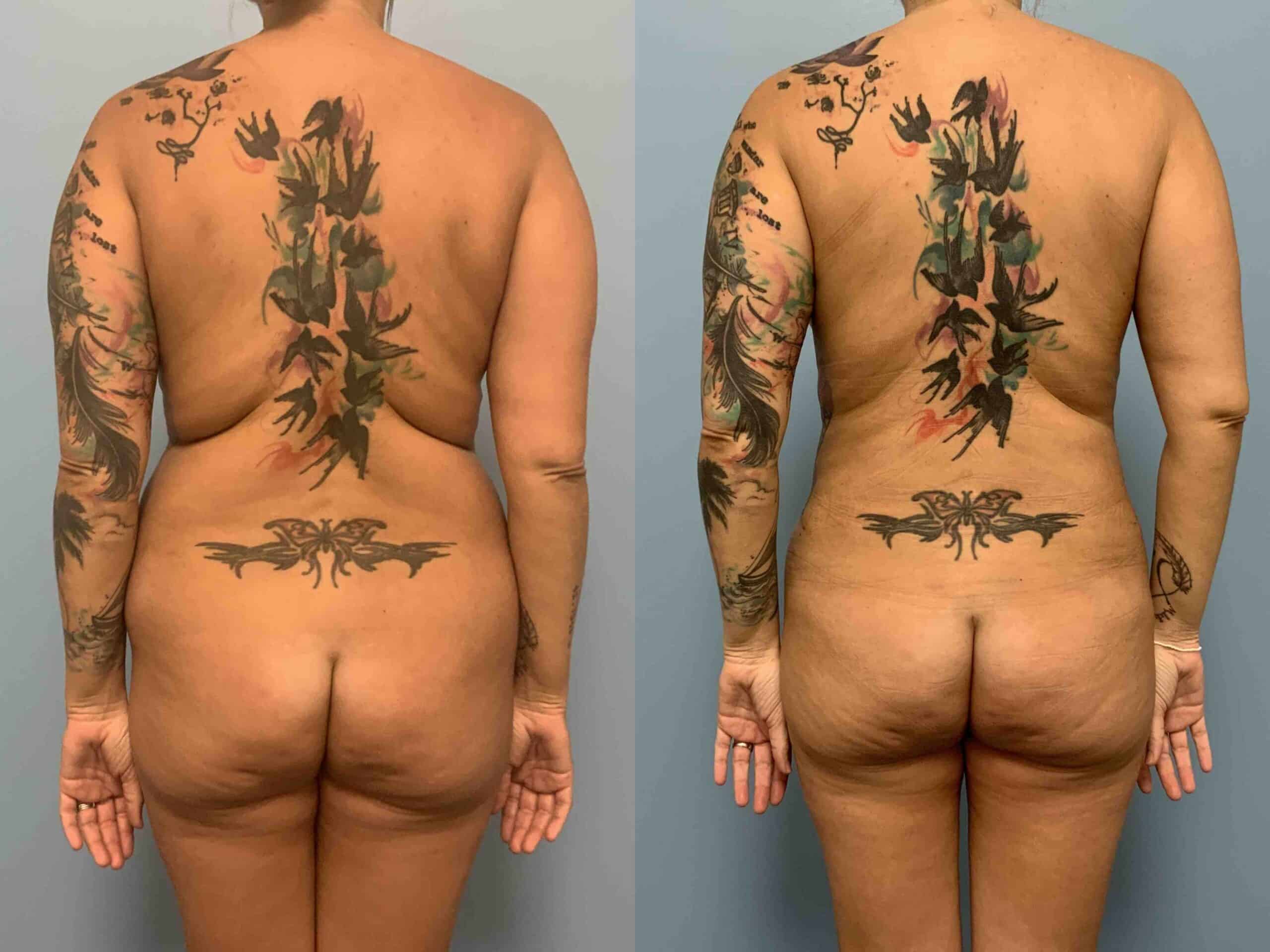 Before and after, 1 mo post op from VASER Abdomen, Axilla, Flanks, and Mons, Tummy Tuck, Breast Lift/Mastopexy performed by Dr. Paul Vanek (rear view)