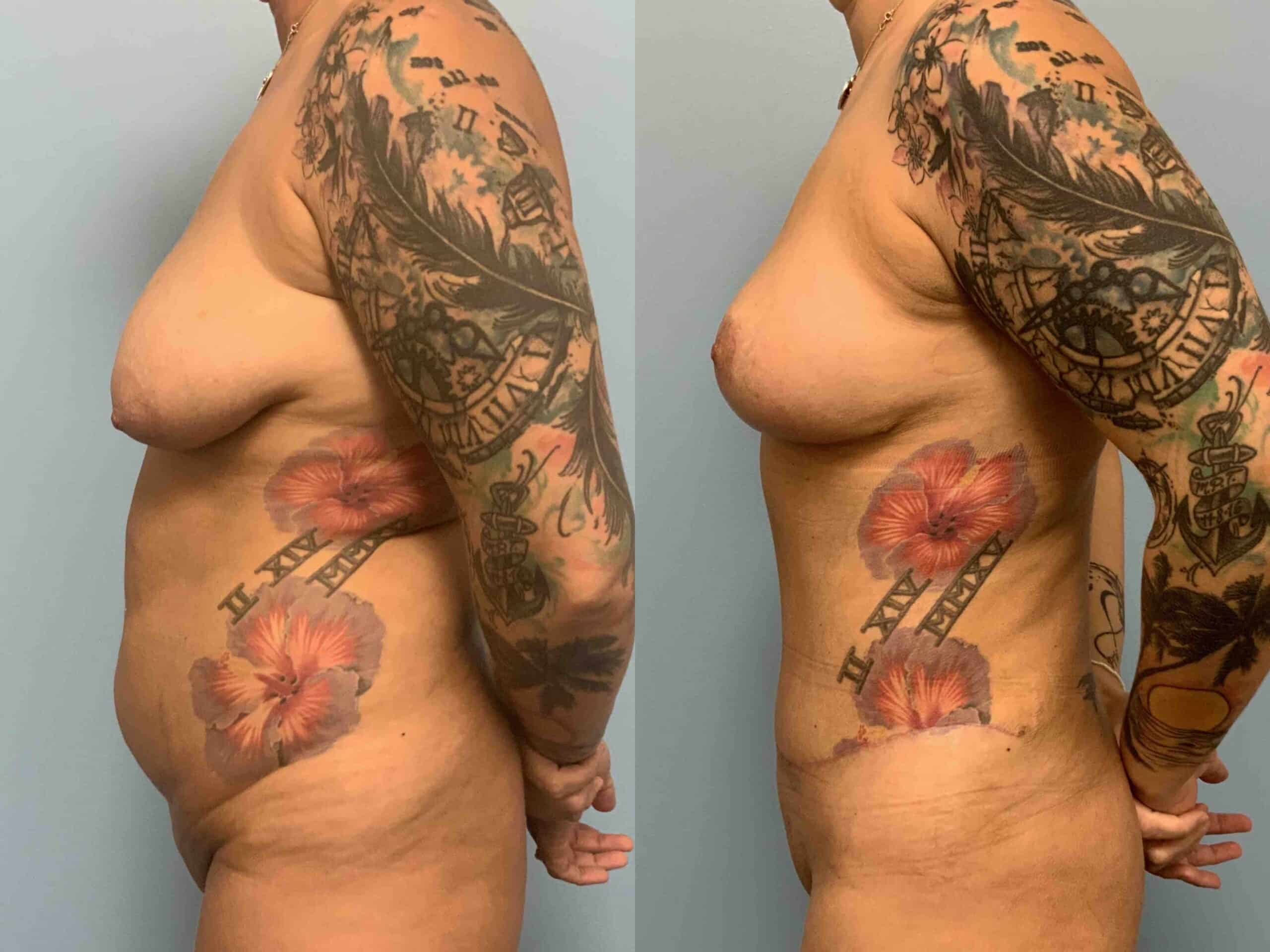 Before and after, 1 mo post op from VASER Abdomen, Axilla, Flanks, and Mons, Tummy Tuck, Breast Lift/Mastopexy performed by Dr. Paul Vanek (side view)