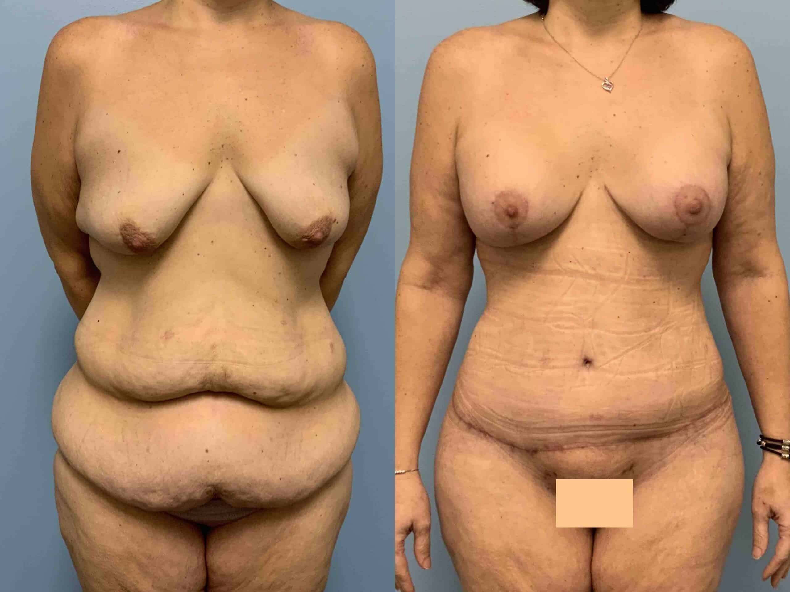 Before and after, 2 mo post op from Tummy Tuck, Belt Lipectomy, VASER Abdomen, Mons, Flanks Axilla, Axillary Roll Resection Breast Lift/Mastopexy, Breast Augmentation performed by Dr. Paul Vanek (front view)