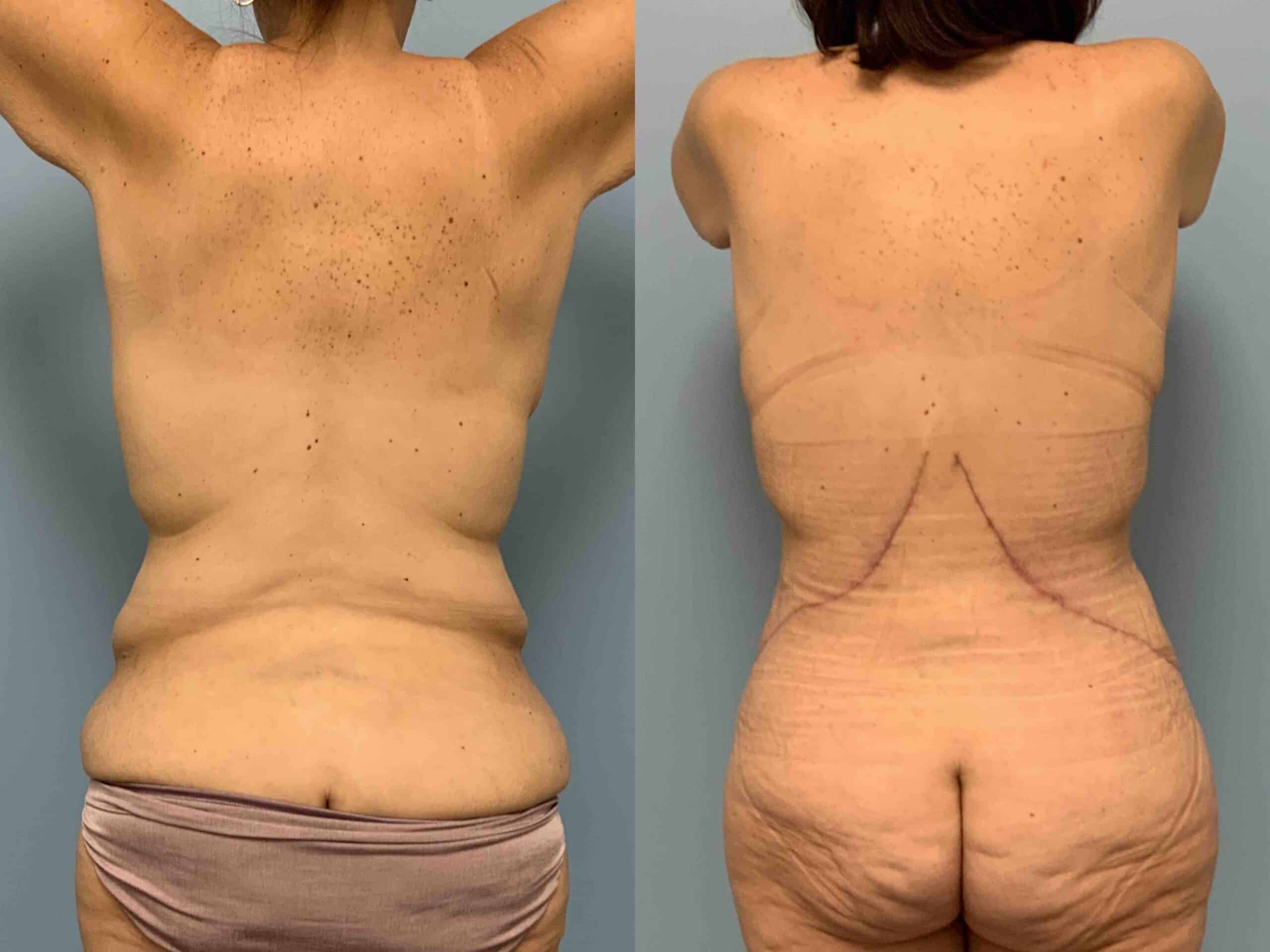 Before and after, 2 mo post op from Tummy Tuck, Belt Lipectomy, VASER Abdomen, Mons, Flanks Axilla, Axillary Roll Resection Breast Lift/Mastopexy, Breast Augmentation performed by Dr. Paul Vanek (back view)