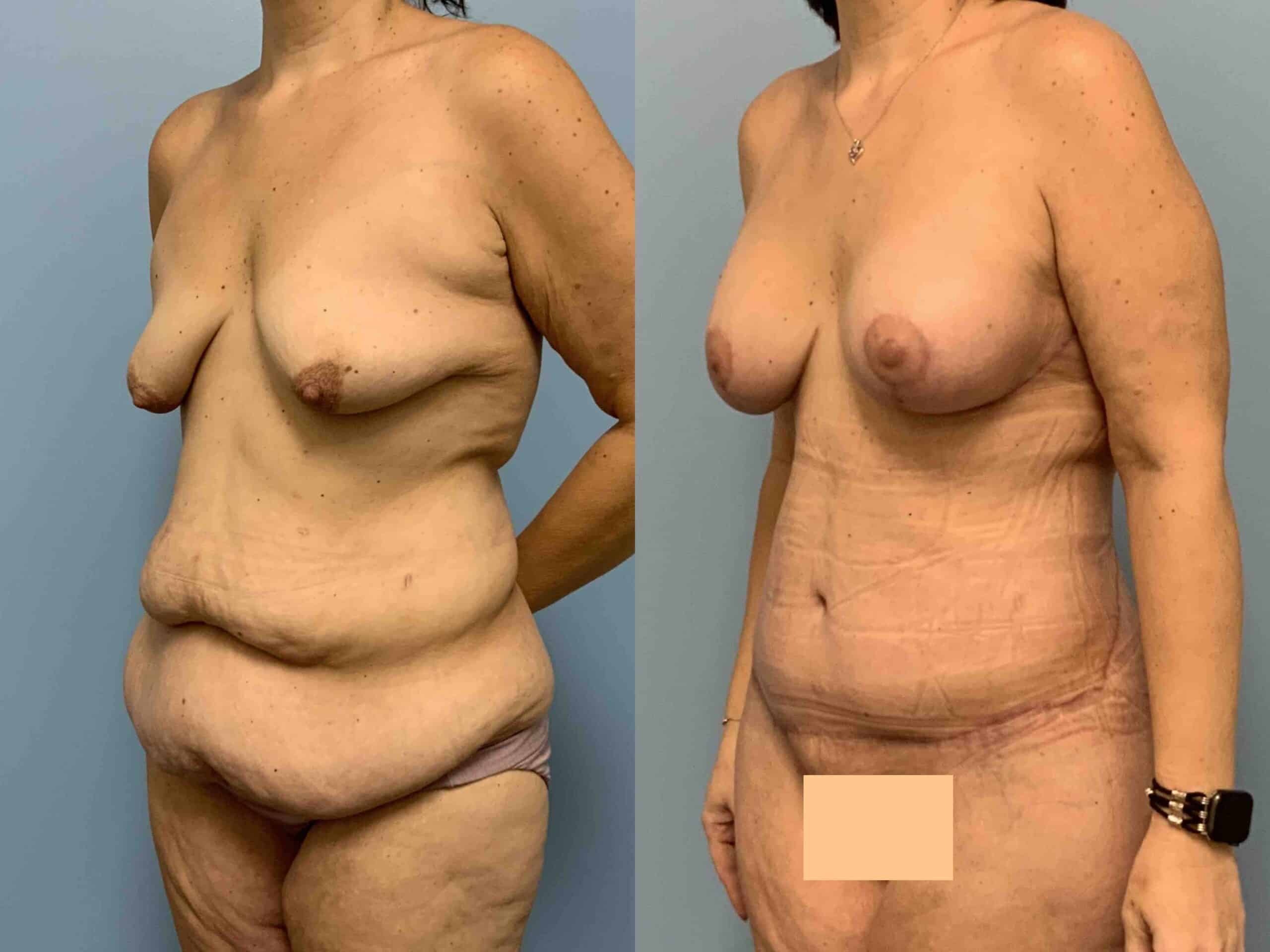 Before and after, 2 mo post op from Tummy Tuck, Belt Lipectomy, VASER Abdomen, Mons, Flanks Axilla, Axillary Roll Resection Breast Lift/Mastopexy, Breast Augmentation performed by Dr. Paul Vanek (diagonal view)
