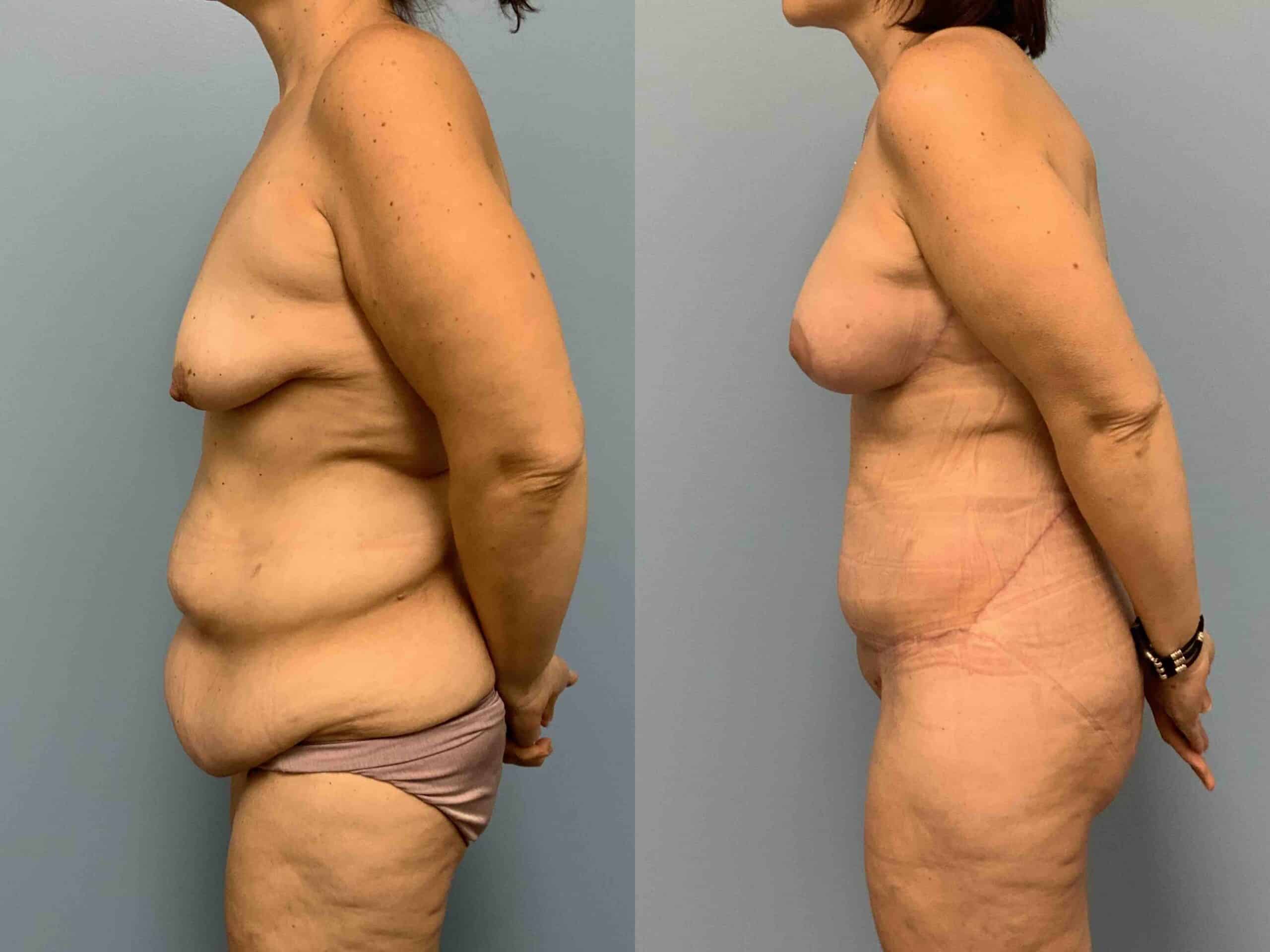Before and after, 2 mo post op from Tummy Tuck, Belt Lipectomy, VASER Abdomen, Mons, Flanks Axilla, Axillary Roll Resection Breast Lift/Mastopexy, Breast Augmentation performed by Dr. Paul Vanek (side view)