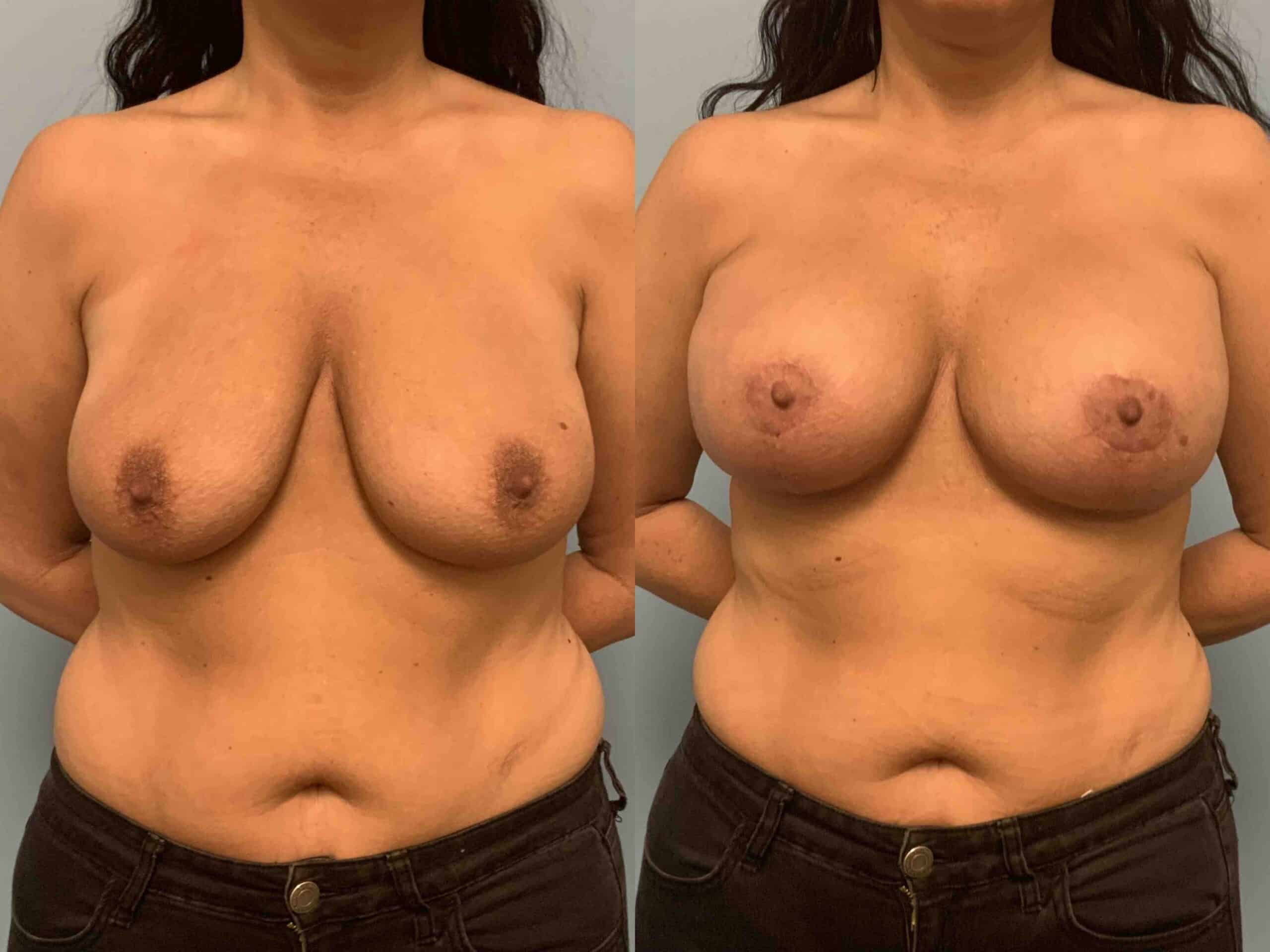Before and after, 1 mo post op from Breast Lift/Mastopexy, Breast Augmentation, Axillary Roll Resection (front view)