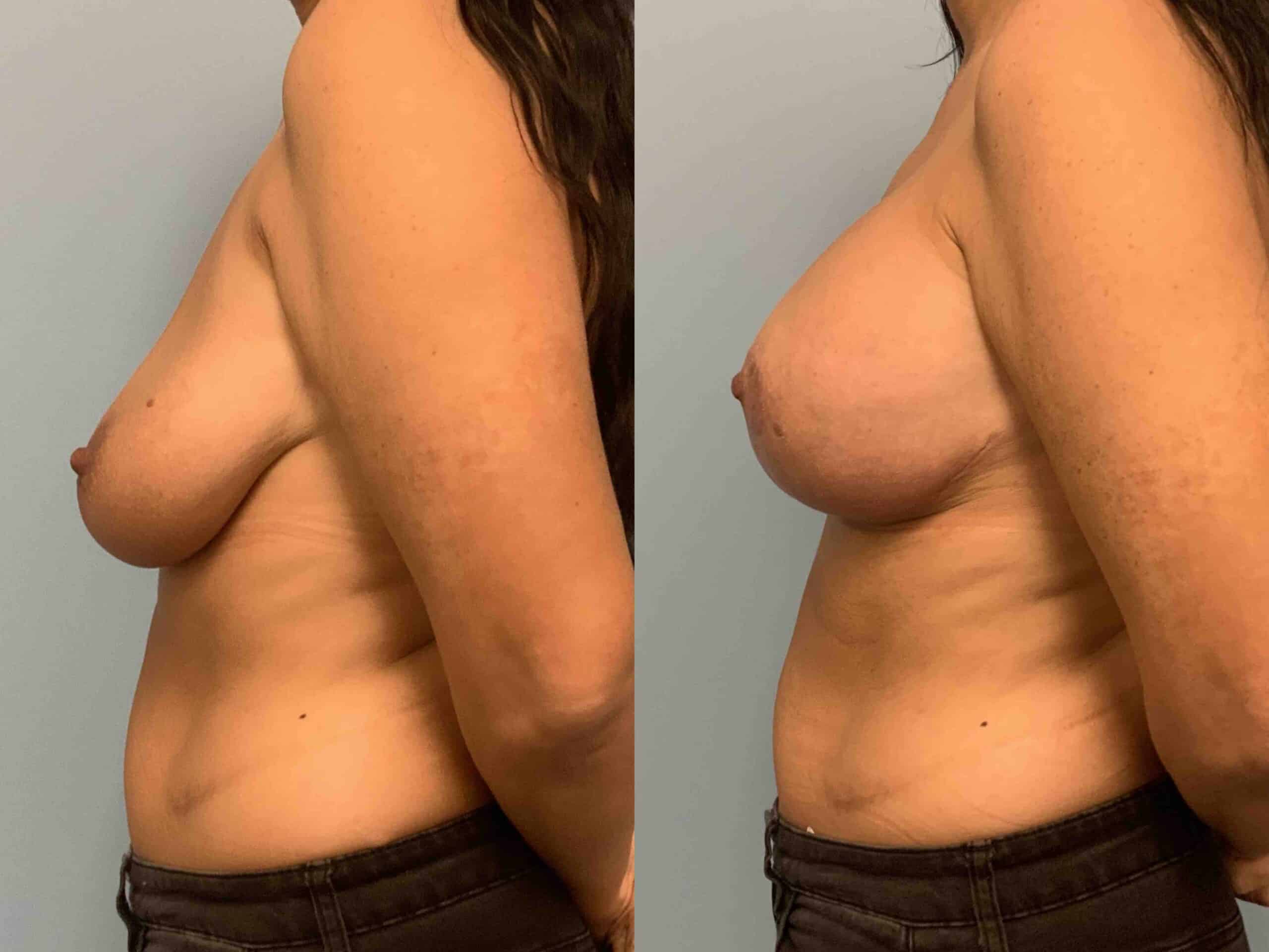 Before and after, 1 mo post op from Breast Lift/Mastopexy, Breast Augmentation, Axillary Roll Resection (side view)