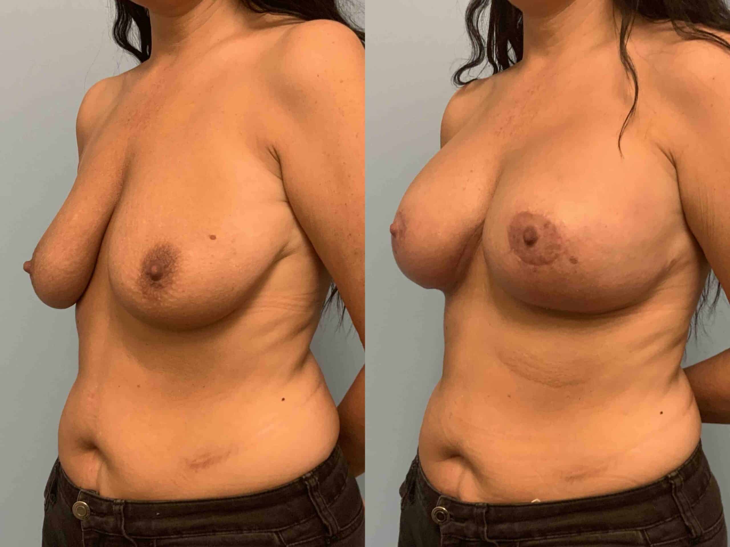 Before and after, 1 mo post op from Breast Lift/Mastopexy, Breast Augmentation, Axillary Roll Resection (diagonal view)