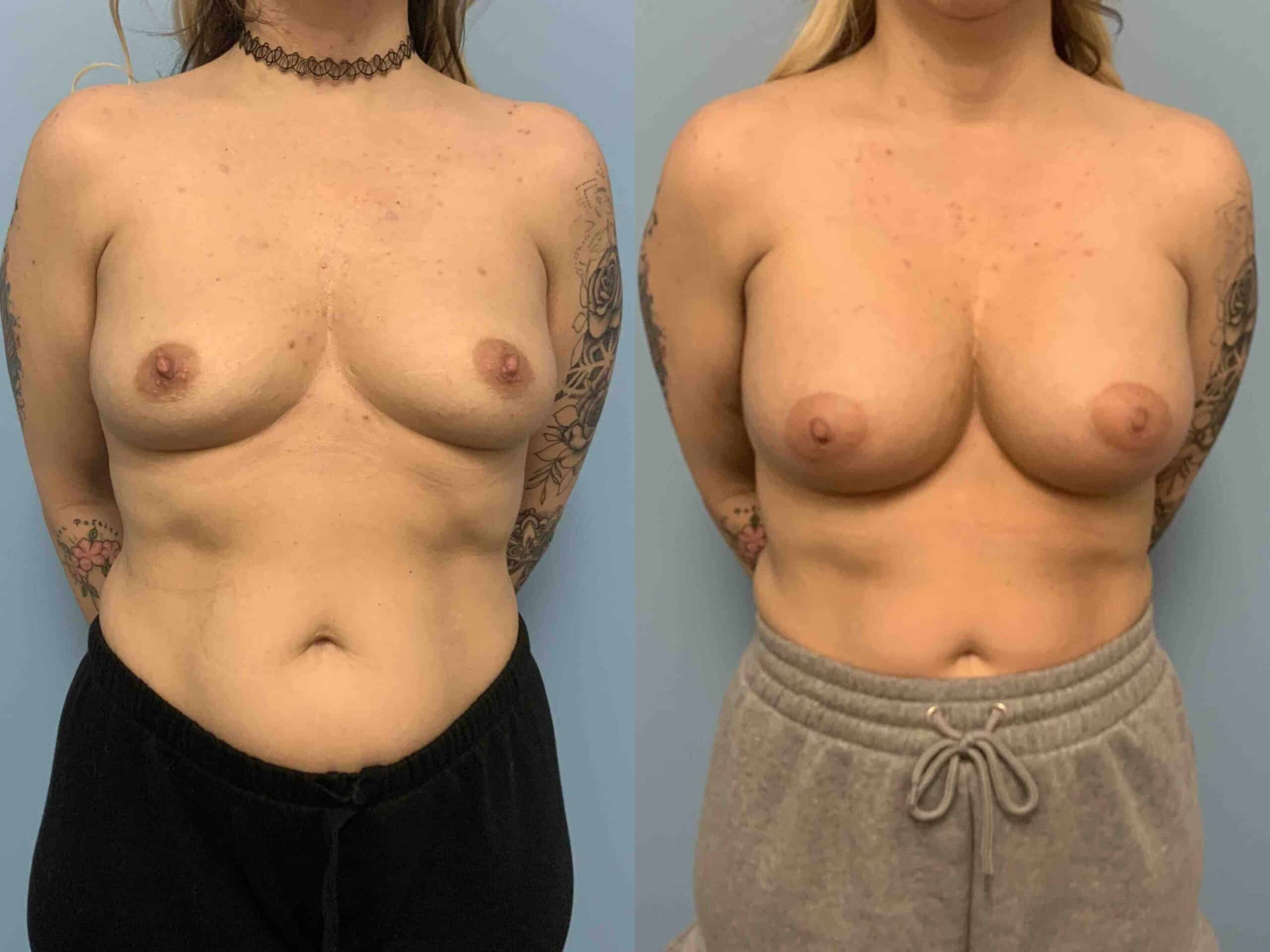 Before and after, 1 mo post op from Breast Augmentation, Level III Muscle Release performed by Dr. Paul Vanek (front view