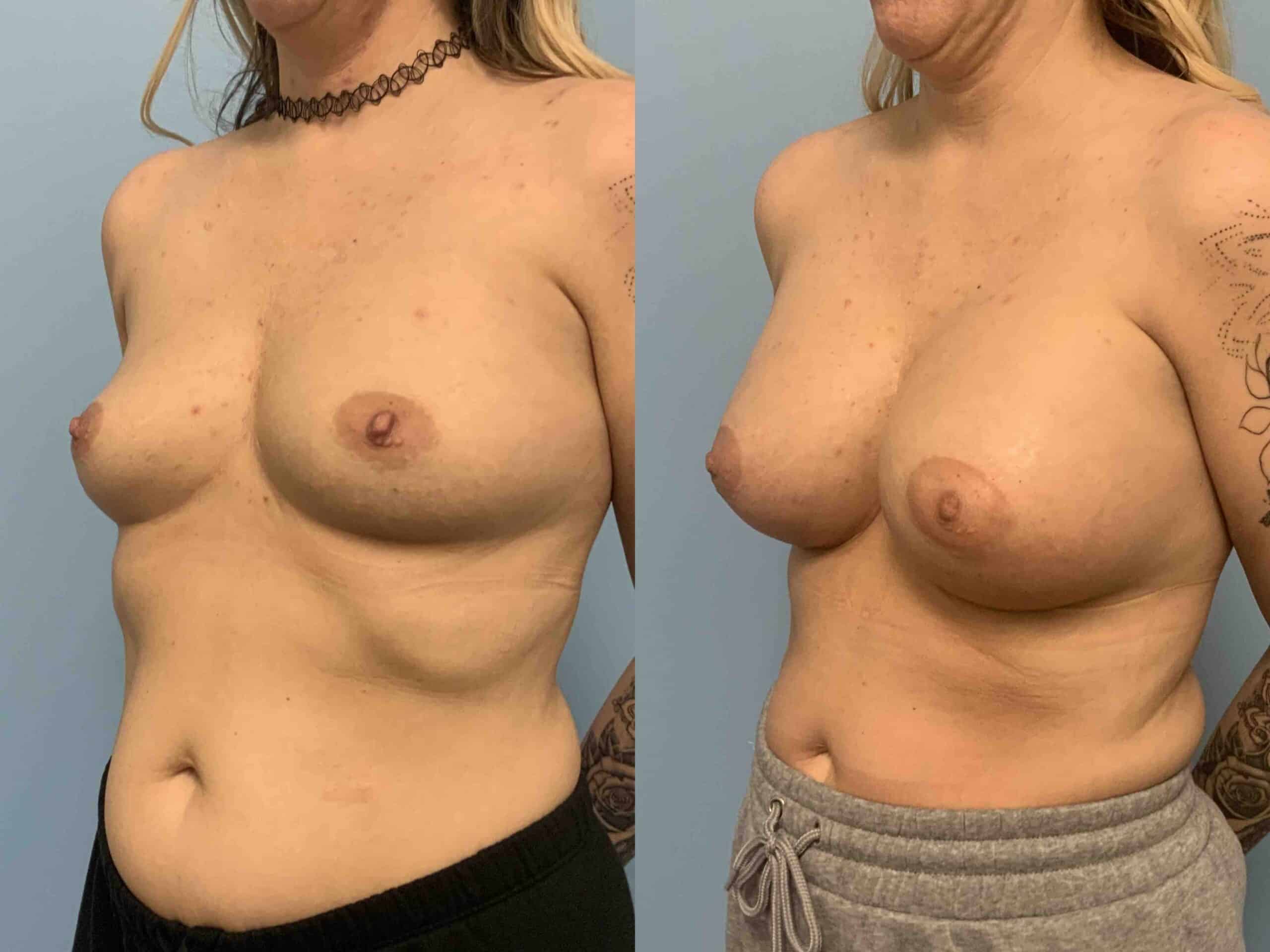 Before and after, 1 mo post op from Breast Augmentation, Level III Muscle Release performed by Dr. Paul Vanek (diagonal view)