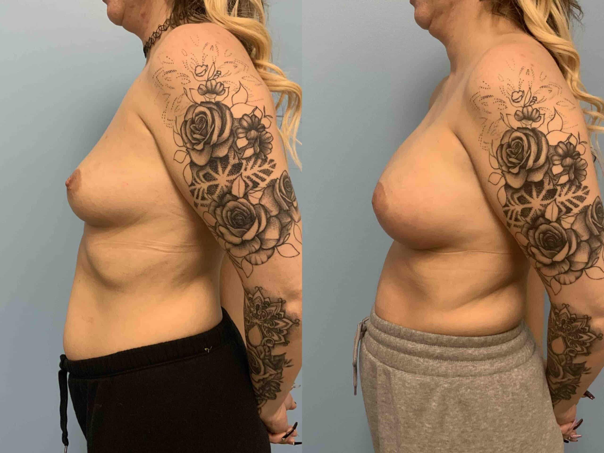 Before and after, 1 mo post op from Breast Augmentation, Level III Muscle Release performed by Dr. Paul Vanek (side view)