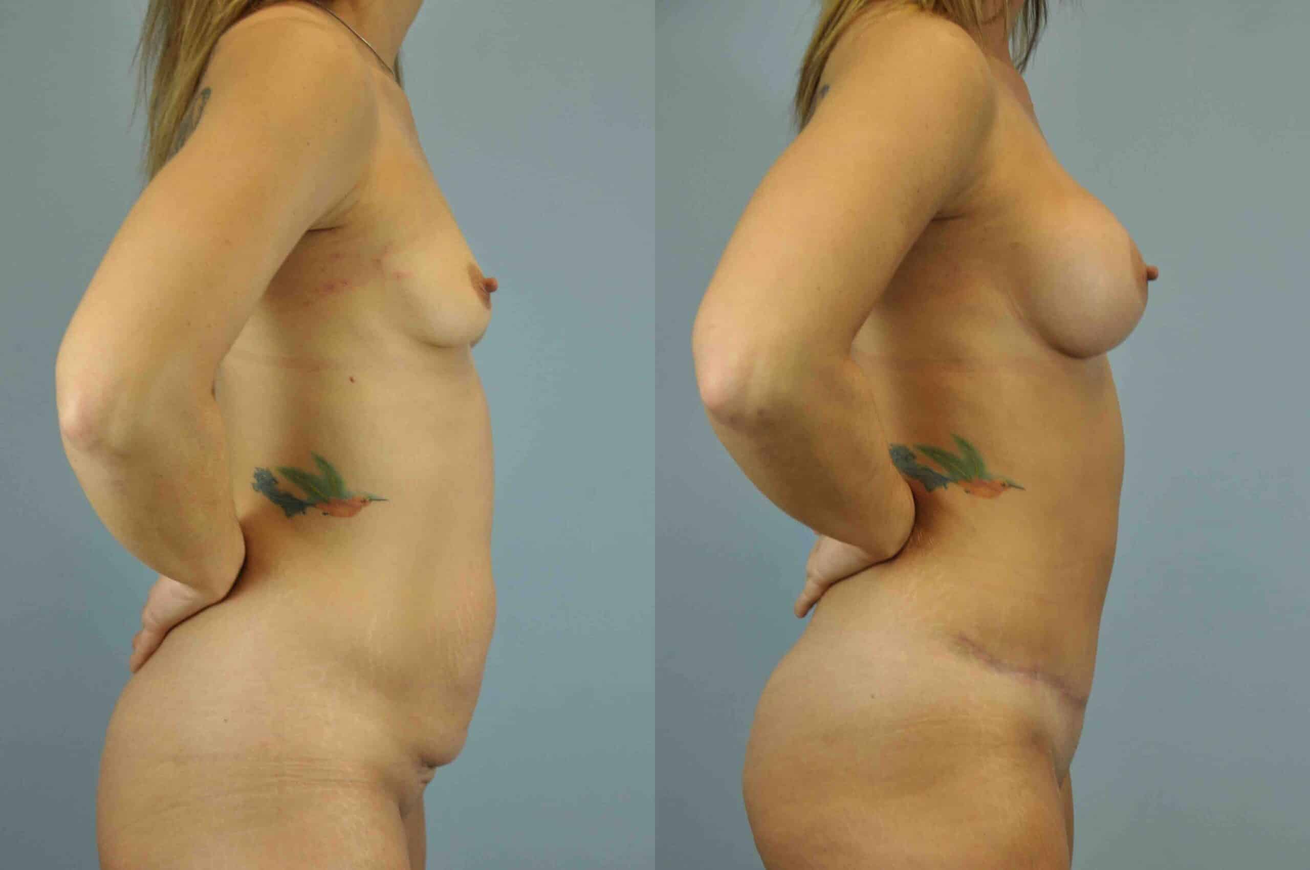 Before and after, 2 mo post op from Tummy Tuck, Breast Augmentation performed by Dr. Paul Vanek (side view)