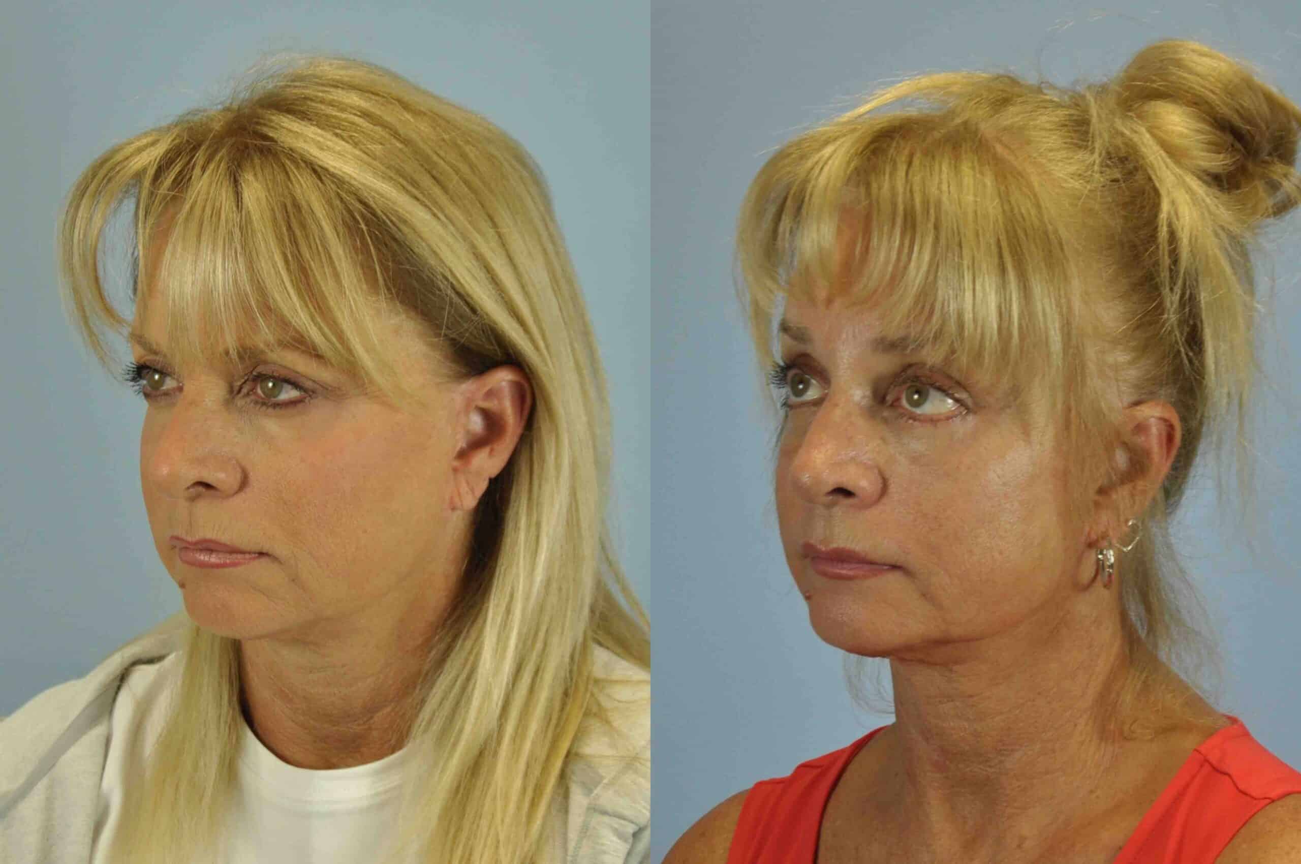 Before and after, 2 mo post op from Lower Blepharoplasty, Canthopexy, Brow Lift performed by Dr. Paul Vanek (diagonal view)
