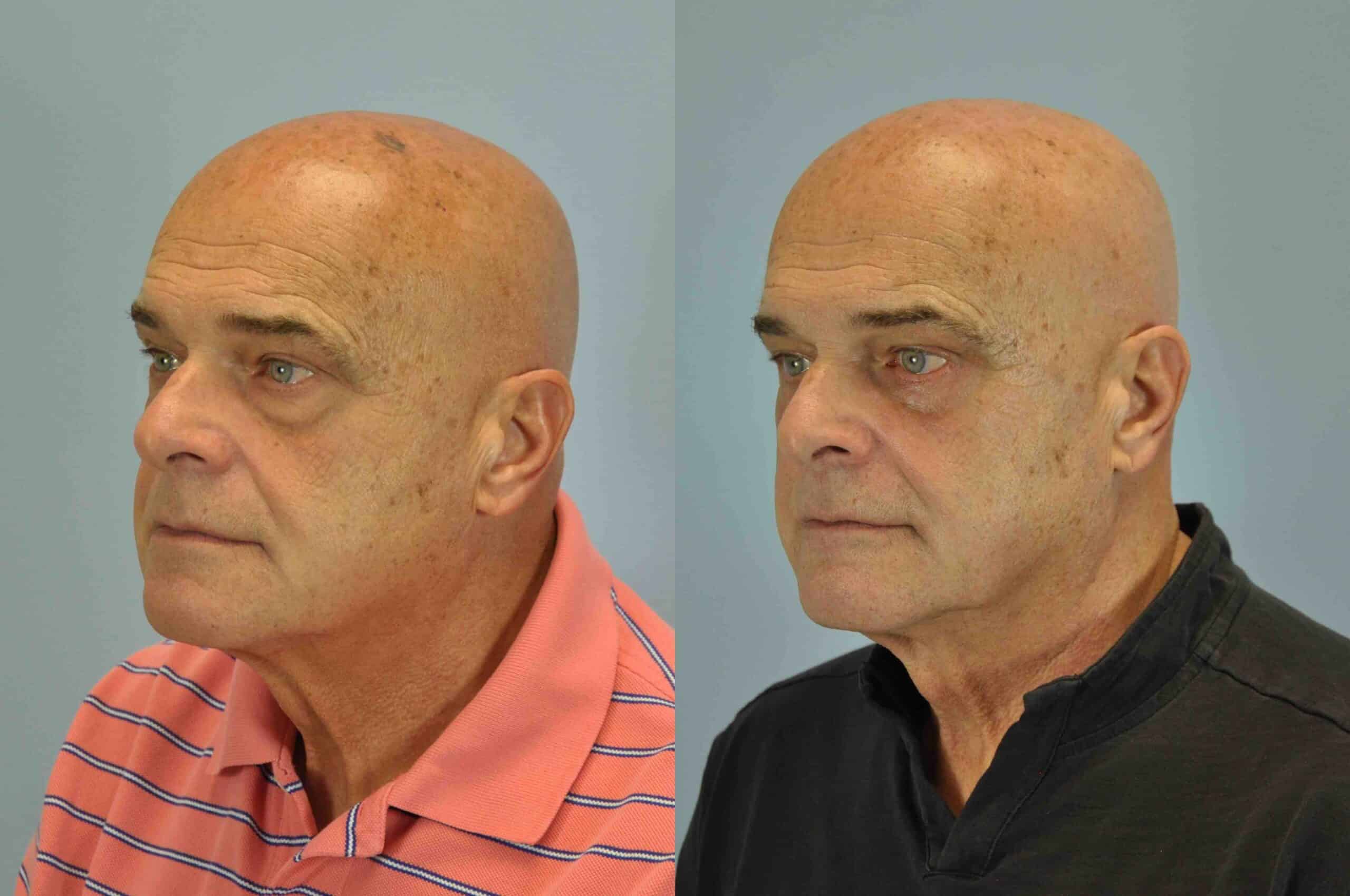 Before and after, 3 mo post op from lower blepharoplasty, canthopexy performed by Dr. Paul Vanek (diagonal view)