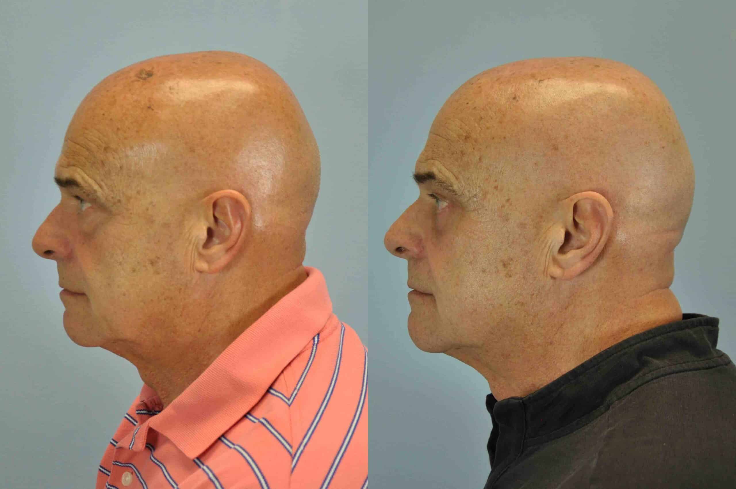 Before and after, 3 mo post op from lower blepharoplasty, canthopexy performed by Dr. Paul Vanek (side view)