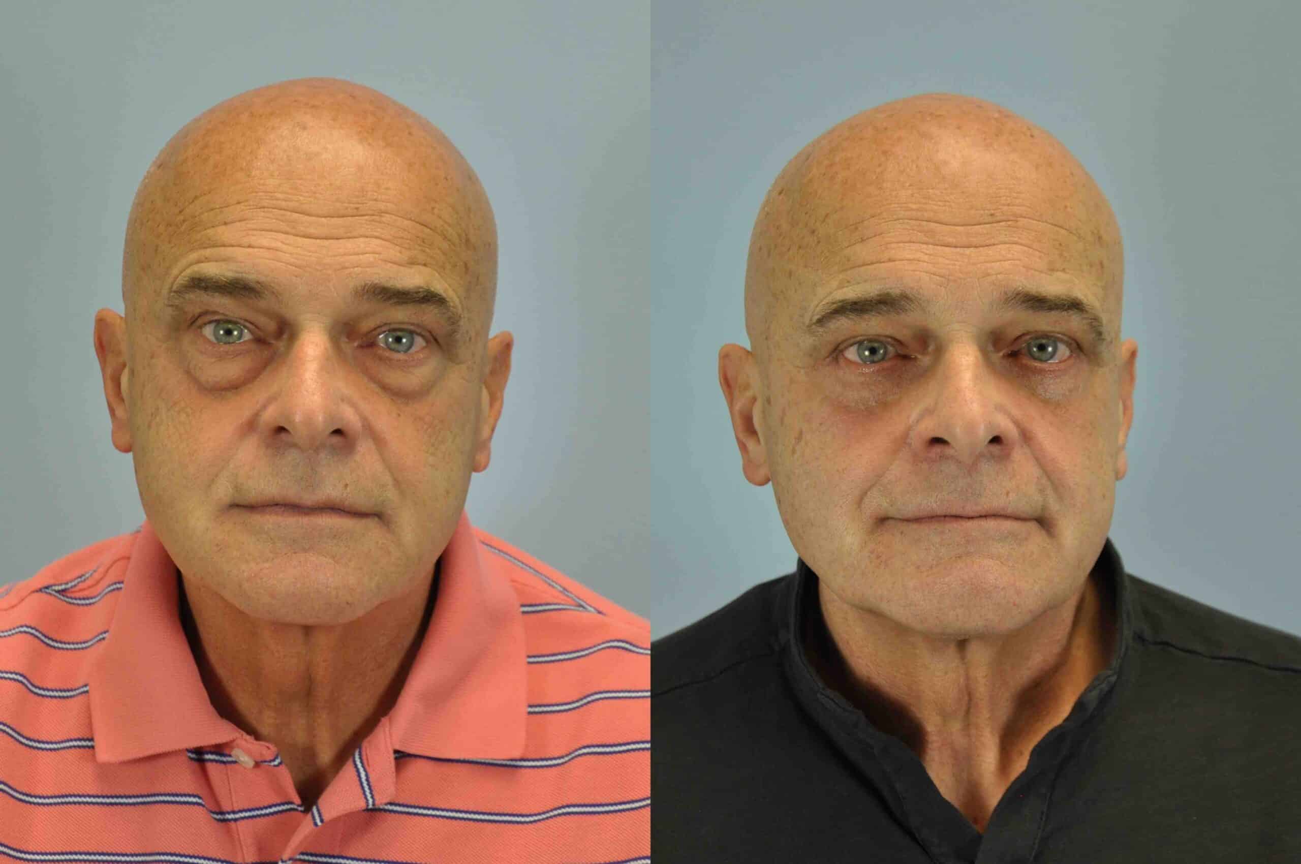 Before and after, 3 mo post op from lower blepharoplasty, canthopexy performed by Dr. Paul Vanek (front view)