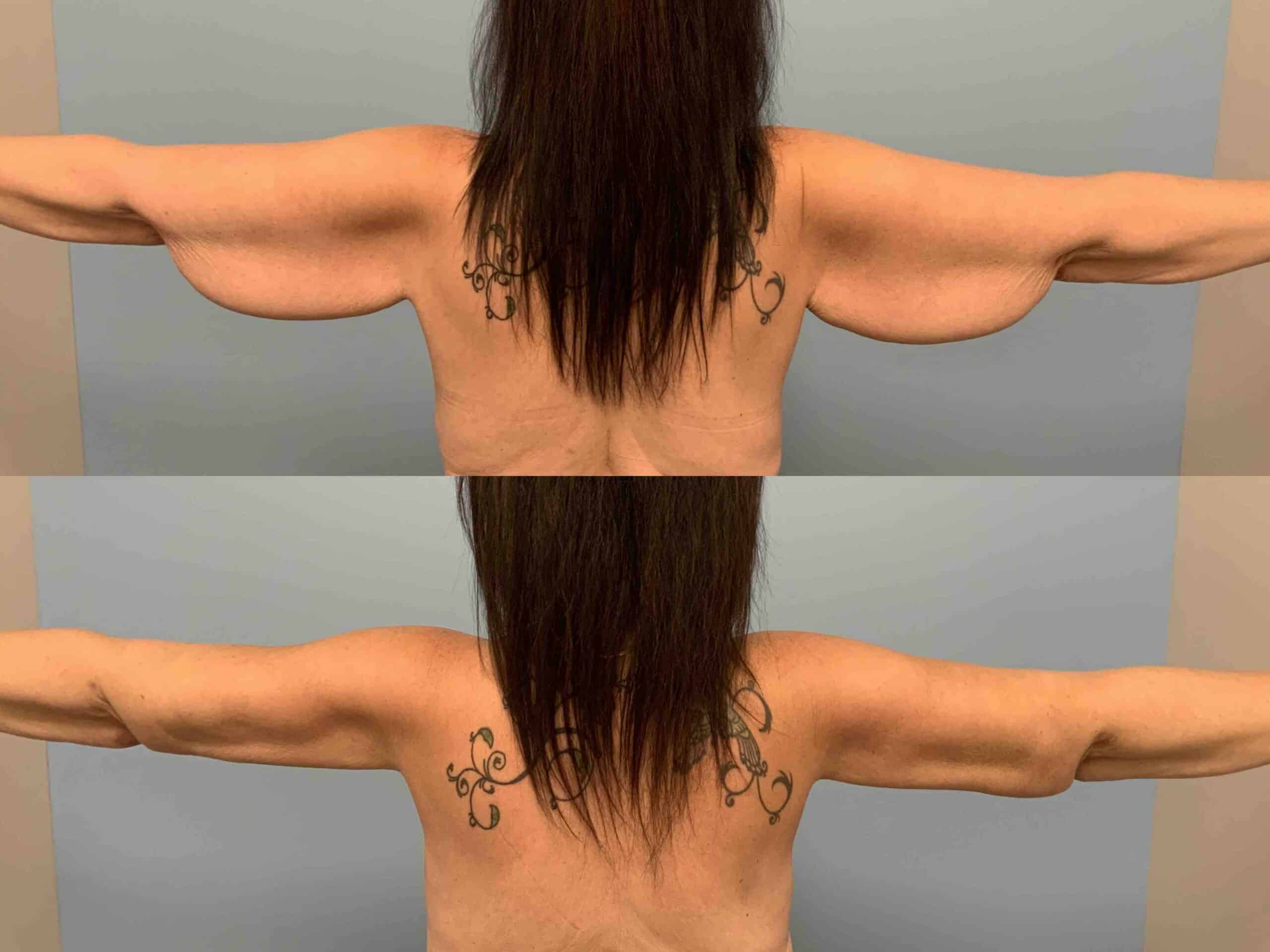 Before and after, 3 mo post op from brachioplasty VASER arms performed by Dr. Paul Vanek (back view)