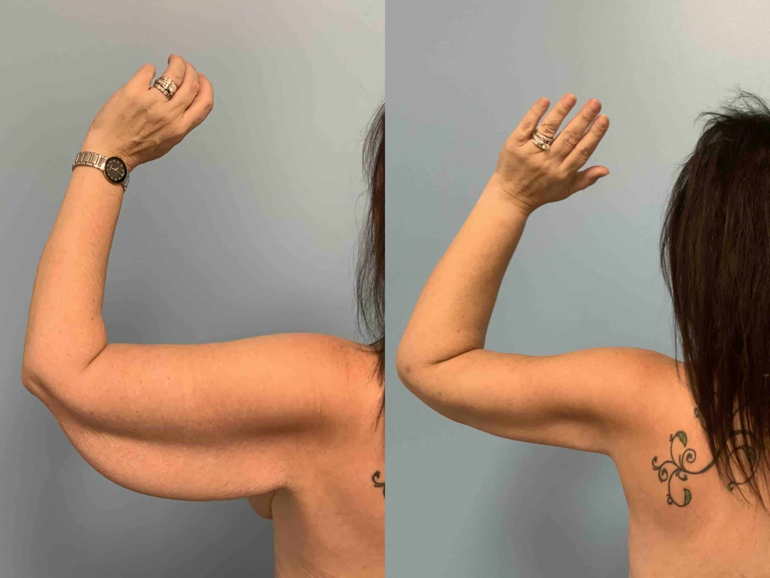 Before and after, 3 mo post op from brachioplasty VASER arms performed by Dr. Paul Vanek (behind view)