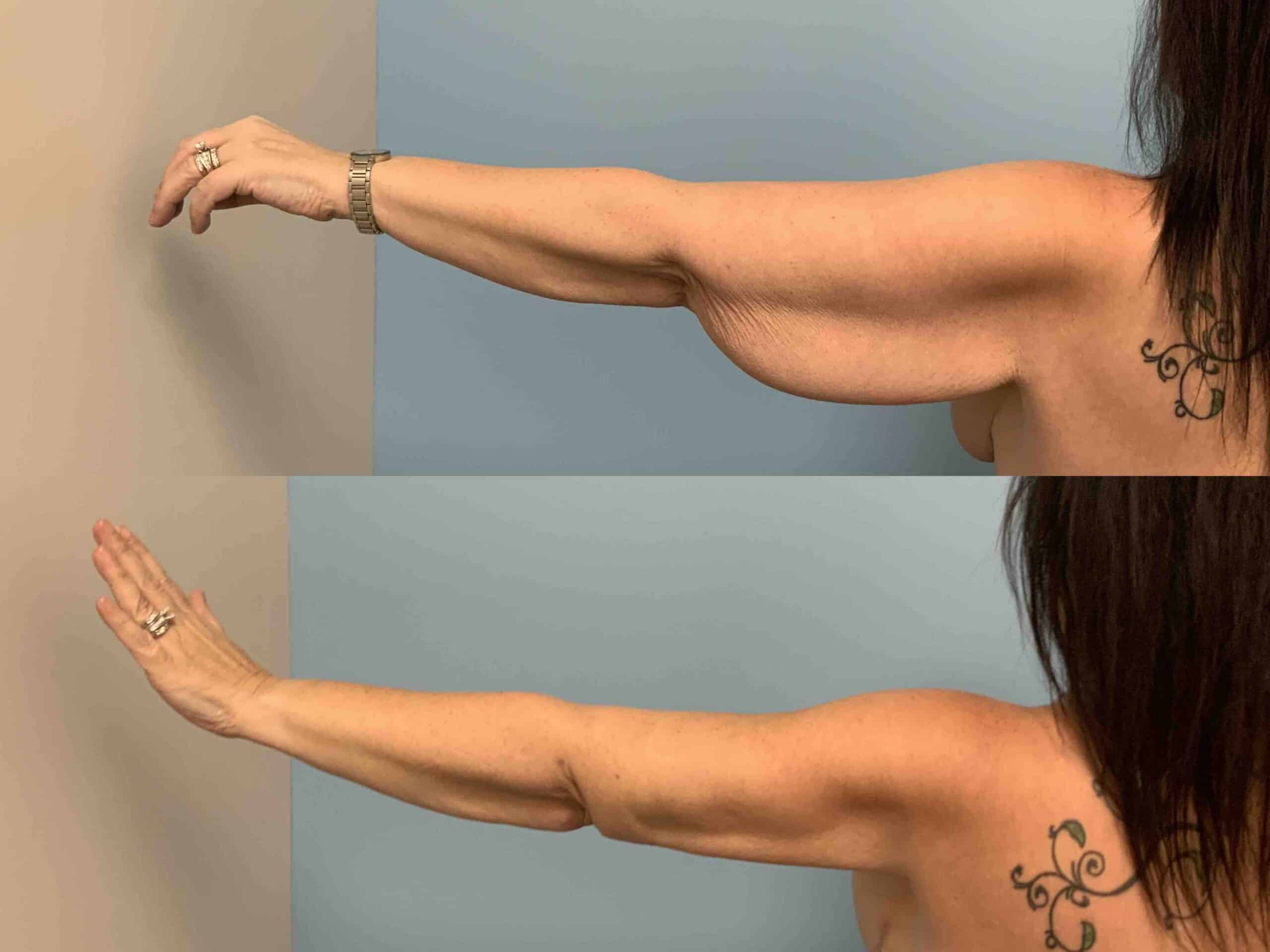 Before and after, 3 mo post op from brachioplasty VASER arms performed by Dr. Paul Vanek (straight arm, behind)