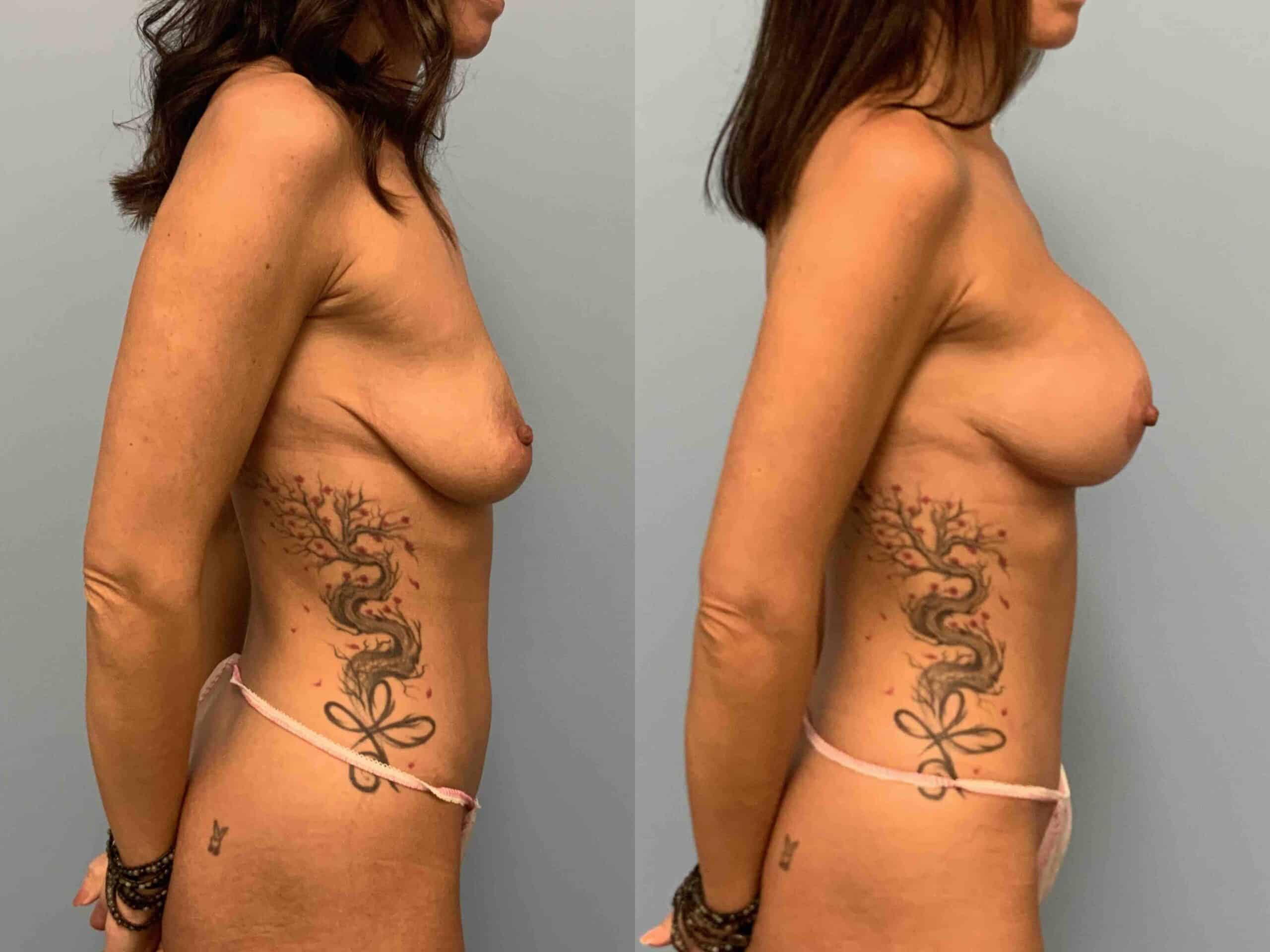 Side view of before and after 3 mo post op from Breast Augmentation, Breast Lift, Tummy Tuck, Monsplasty performed by Dr. Paul Vanek