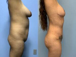 Renuvion for Abdominoplasty