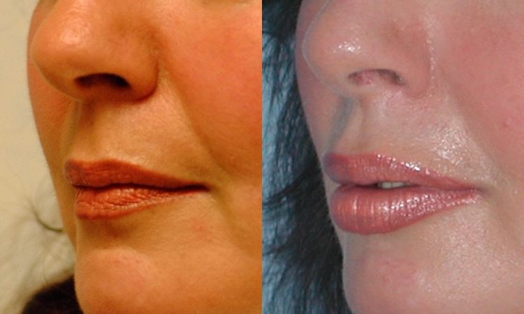 Before and after, patient 1 mo post op from Lip Augmentation with Fat Transfer procedure performed by Dr. Paul Vanek
