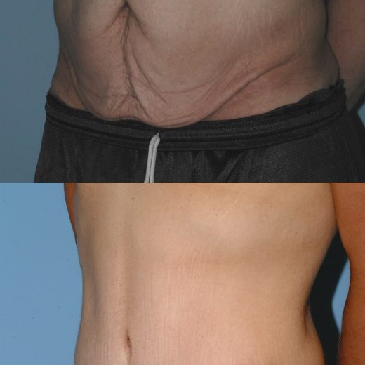 Before and after, patient 6 mo post op from Tummy Tuck procedure performed by Dr. Paul Vanek