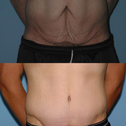 Before and after, patient 6 mo post op from Tummy Tuck procedure performed by Dr. Paul Vanek