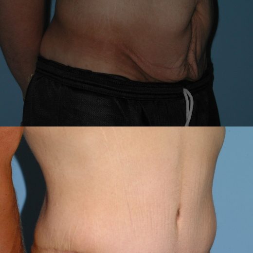 Before and after, patient 6 mo post op from Tummy Tuck procedure performed by Dr. Paul Vanek