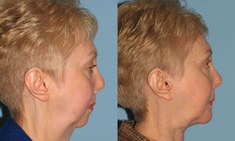 Before and after, patient 1 yr post op after Neck Lift, Facelift, VASER neck, Scar Revision Nose & Cleft Lip, Chin Augmentation w/Implant – Genioplasty procedures performed by Dr. Paul Vanek