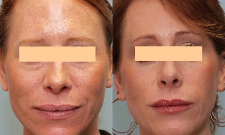 Before and after, patient 7 mo post treatment from Laser Resurfacing, Profractional Laser procedures performed by Dr. Paul Vanek