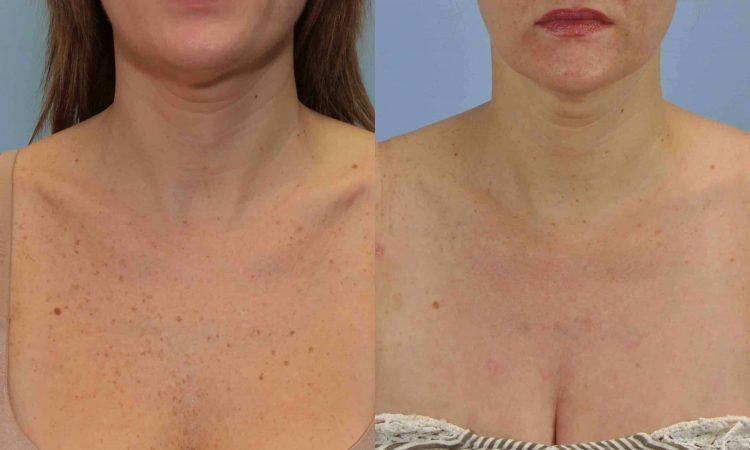 Before and after, patient 2 w post treatment from Broad Band Laser treatment performed by Dr. Paul Vanek