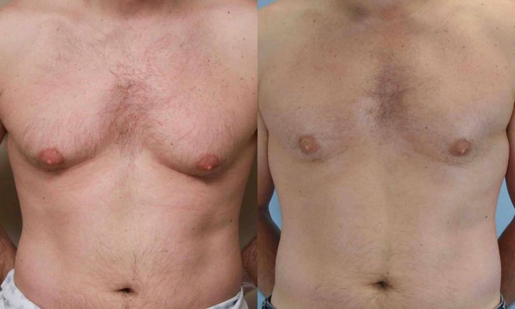 Before and after, patient 3 mo post op from Gynecomastia and VASER chest procedures performed by Dr. Paul Vanek