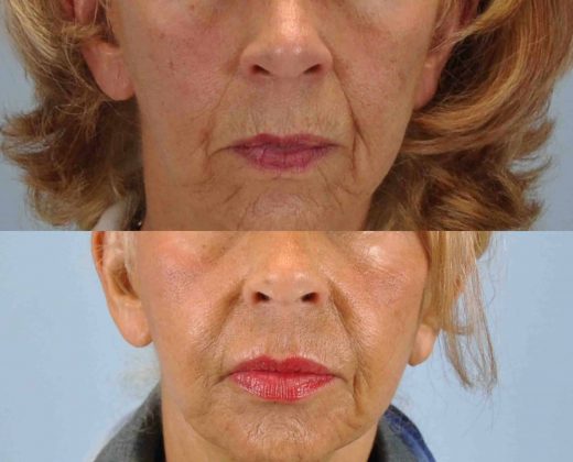 Before and after, Patient 1 mo post op from Mentor Peel and Lip Augmentation procedure performed by Dr. Paul Vanek