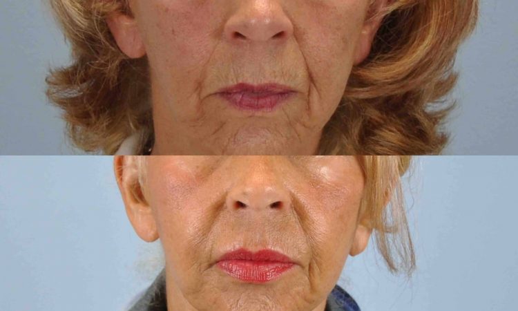Before and after, Patient 1 mo post op from Mentor Peel and Lip Augmentation procedure performed by Dr. Paul Vanek