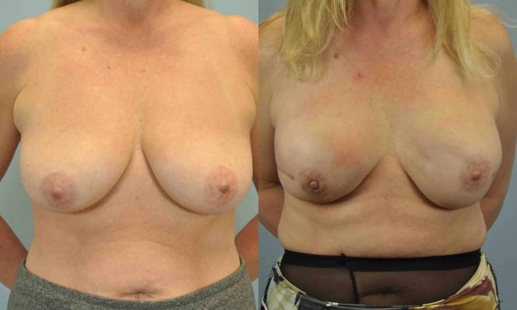 Before and after, 3 mo post op from Single-Stage Breast Reconstruction with Implant, B/L Nipple-Sparing Mastectomy, Alloderm performed by Dr. Paul Vanek (front view)