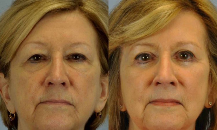 Before and after, patient 3 mo post op from Upper and Lower Blepharoplasty performed by Dr. Paul Vanek