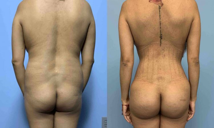 Before and after, patient 1 yr post op from Brazilian Butt Lift, Panniculectomy, Mastopexy/Breast Lift, VASER/Renuvion of the abdomen, flanks, back, and axilla procedures performed by Dr. Paul Vanek